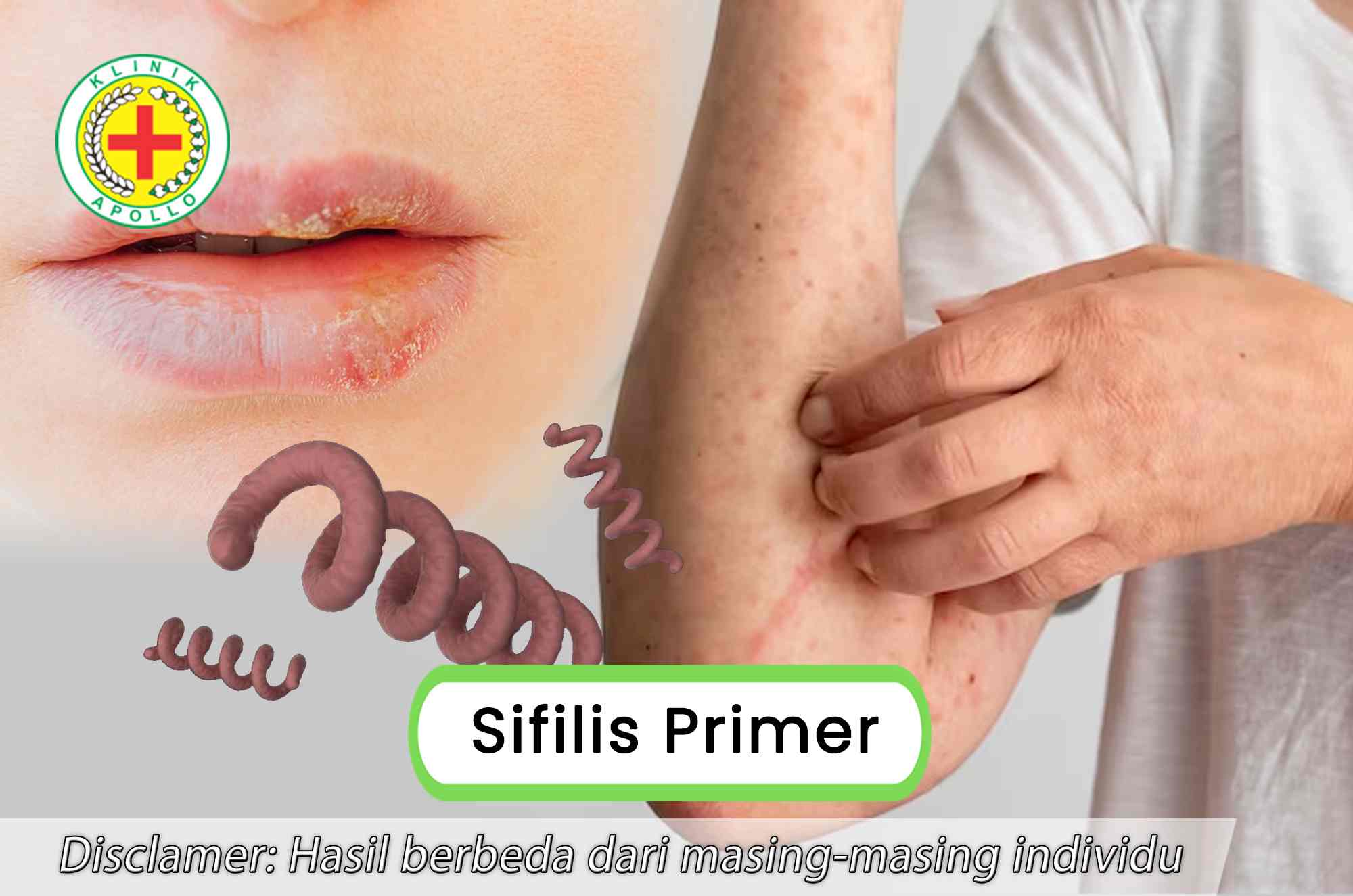 Gejala Sifilis Primer, Tidak Menyakitkan, Berbahaya jika Tak Diobati