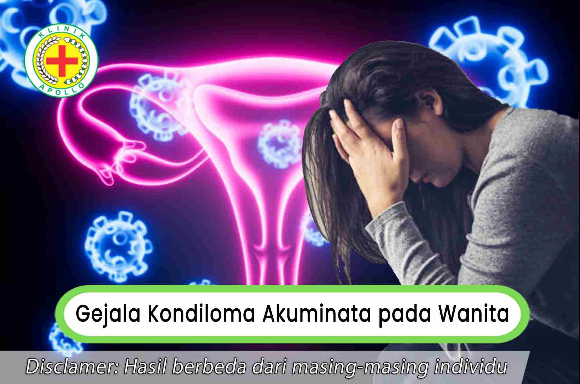 Mengobati gejala kondiloma akuminata pada wanita harus sesuai resep dokter ahli.