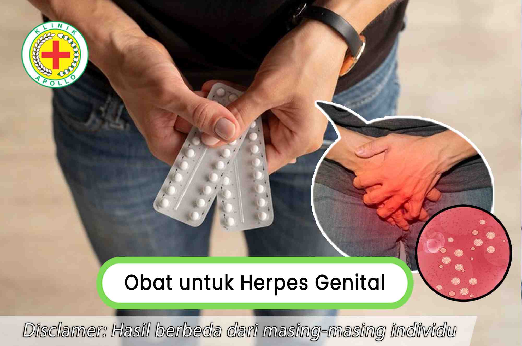 Rekomendasi obat untuk herpes genital yang paling tepat dan terbaik di Klinik Apollo.