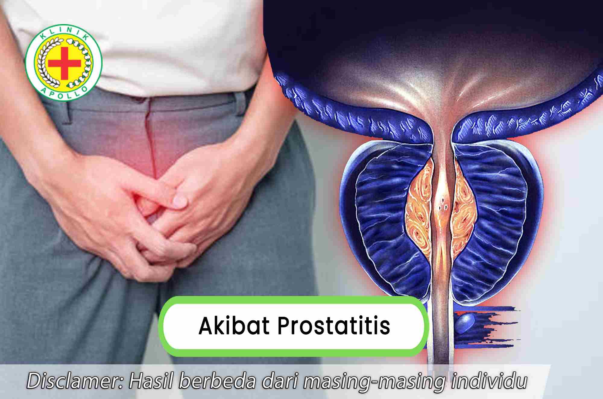 Selalu konsultasikan dengan dokter ahli andrologi untuk mengetahui akibat prostatitis pada pria.