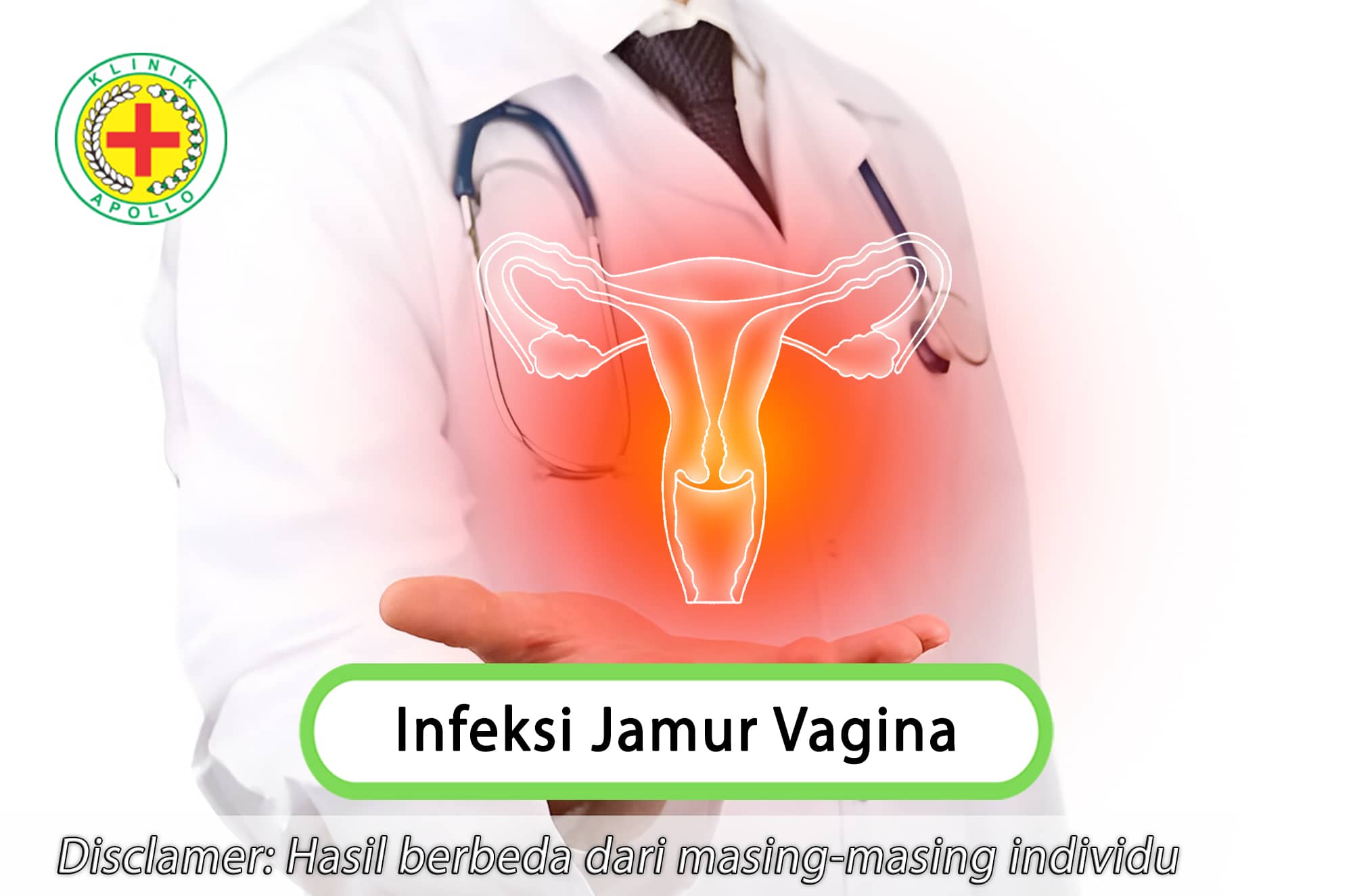Lakukan penanganan untuk infeksi jamur vagina hanya di Klinik Apollo dengan dokter ahli ginekologi.
