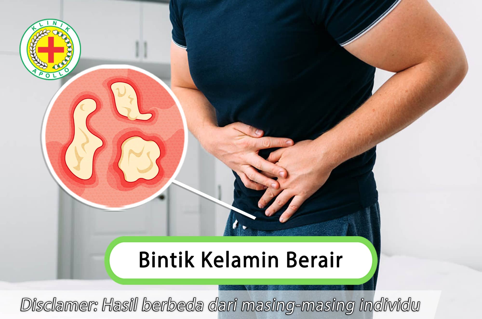 Atasi bintik kelamin berair hanya di Klinik Apollo Jakarta dengan dokter ahli.