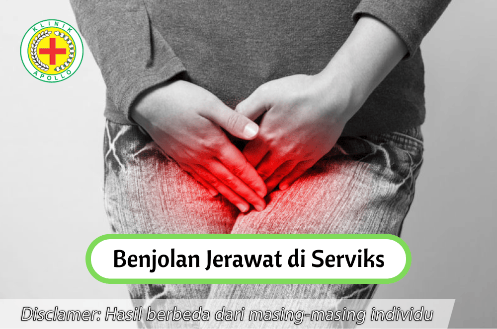 Jangan khawatir ketika mengalami benjolan jerawat di serviks, hubungi dokter ahli di Klinik Apollo.