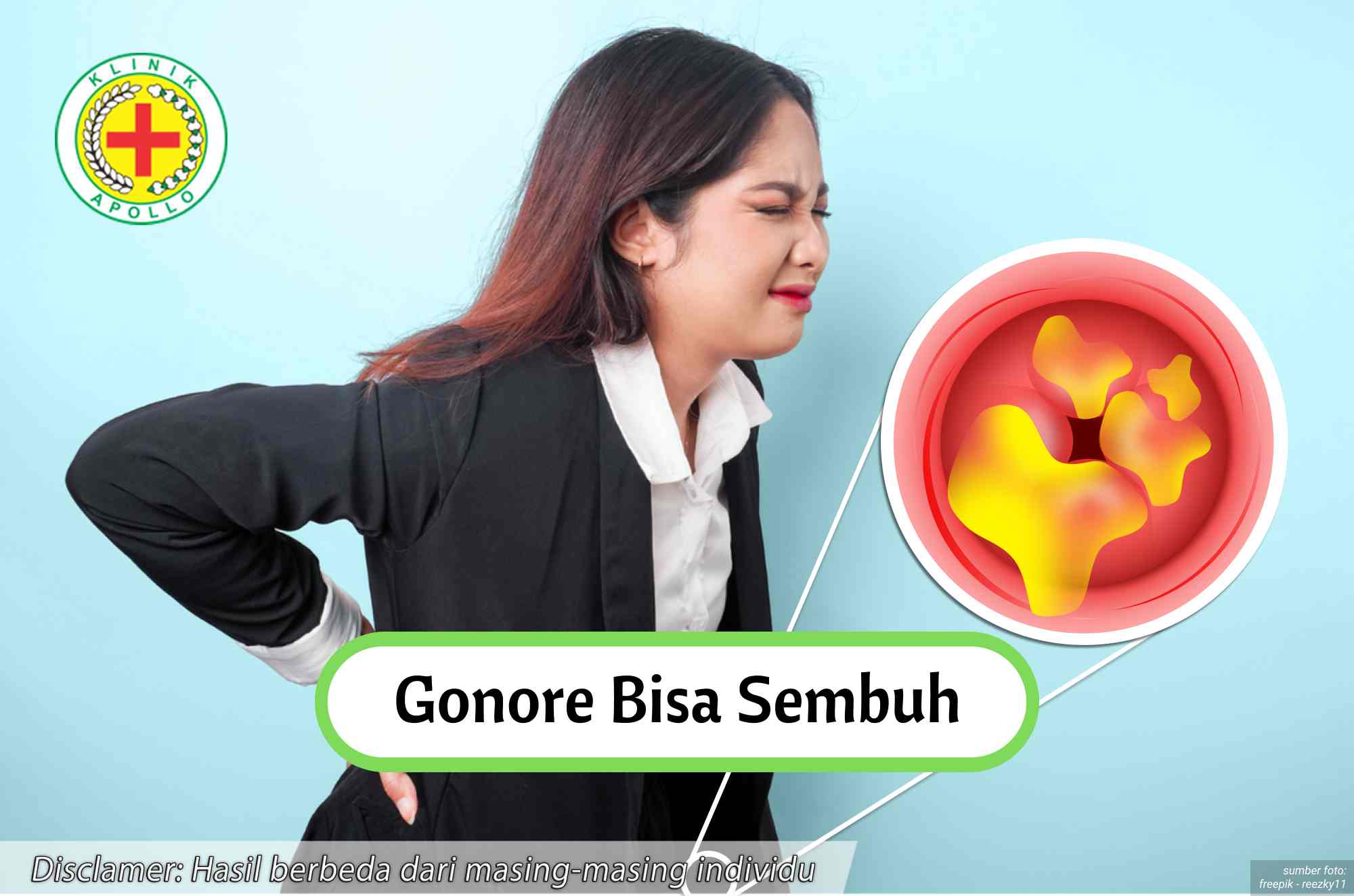 Ilustrasi Gonore Bisa Sembuh.