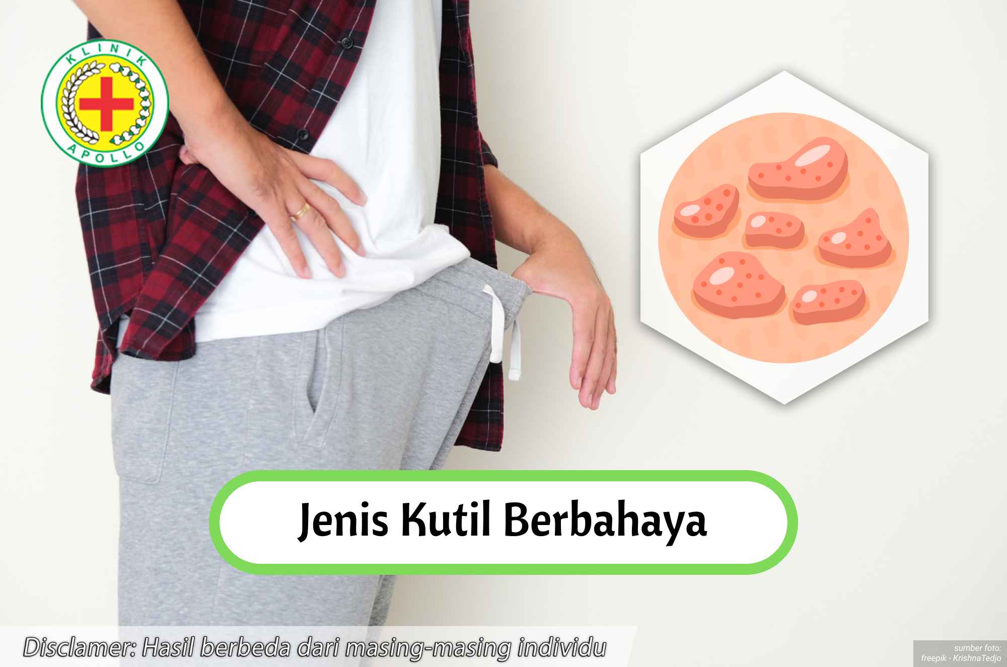 Ilustrasi Jenis Kutil Berbahaya.