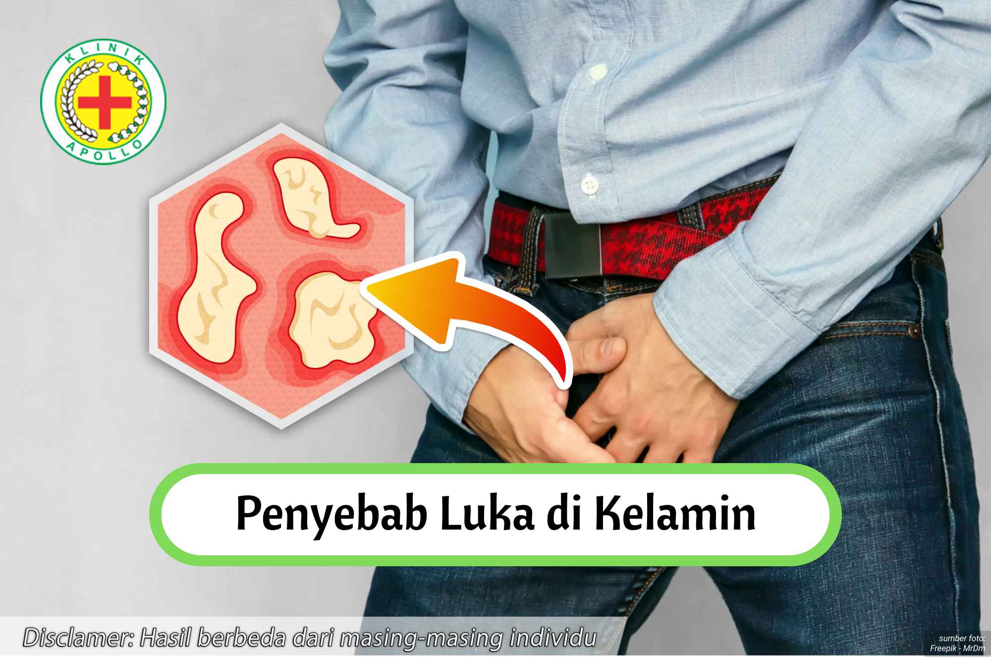 Ilustrasi Penyebab Luka di Kelamin.