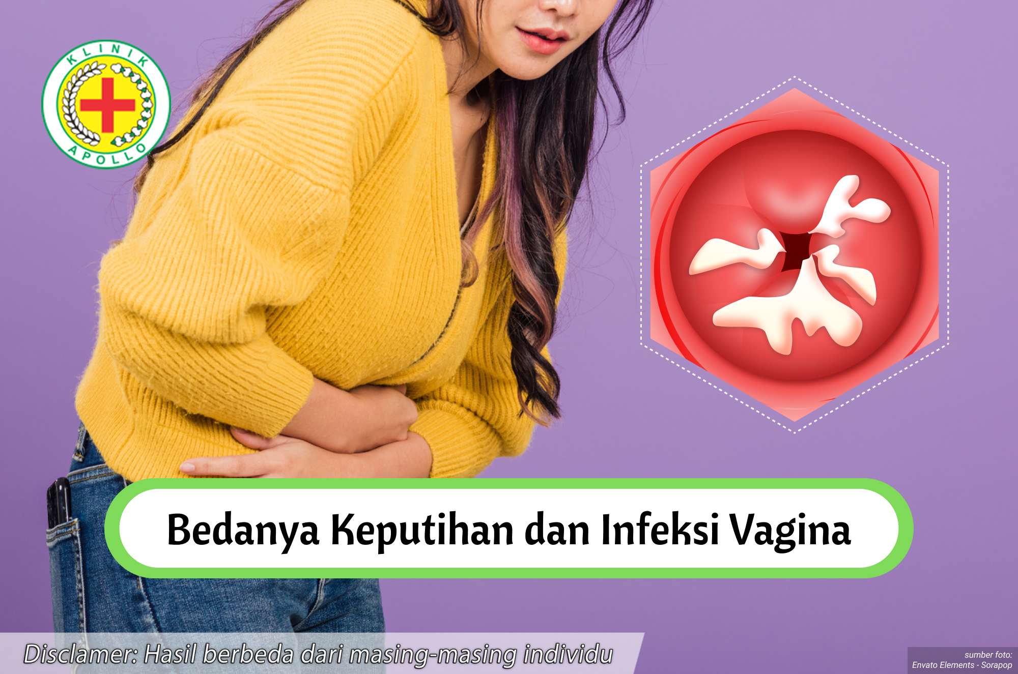 Ilustrasi Seorang Wanita dengan Keputihan dan Infeksi Vagina.