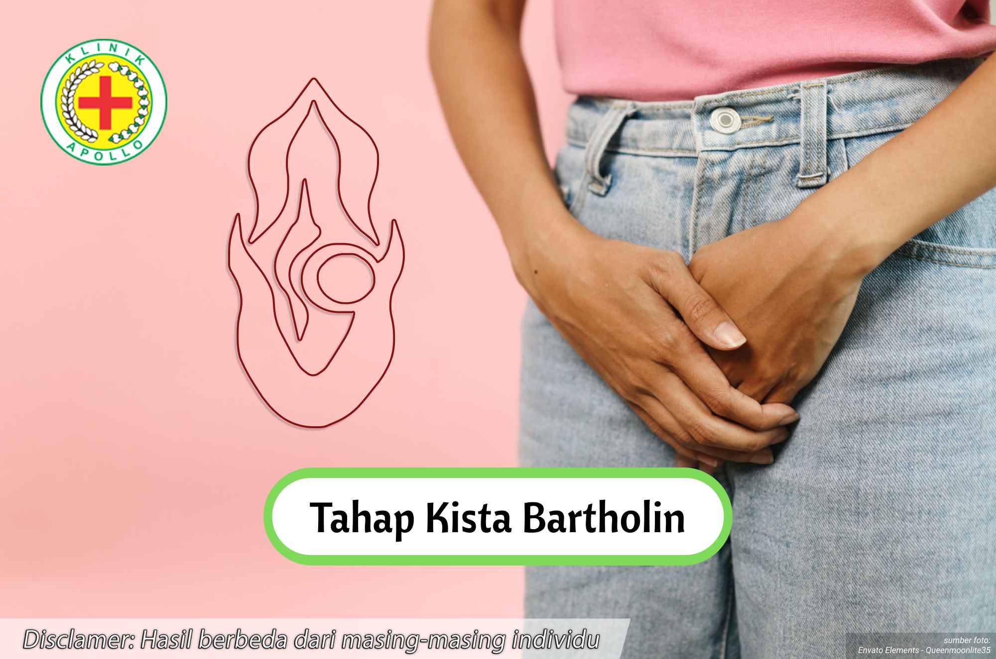 Ilustrasi Tahap Kista Bartholin.