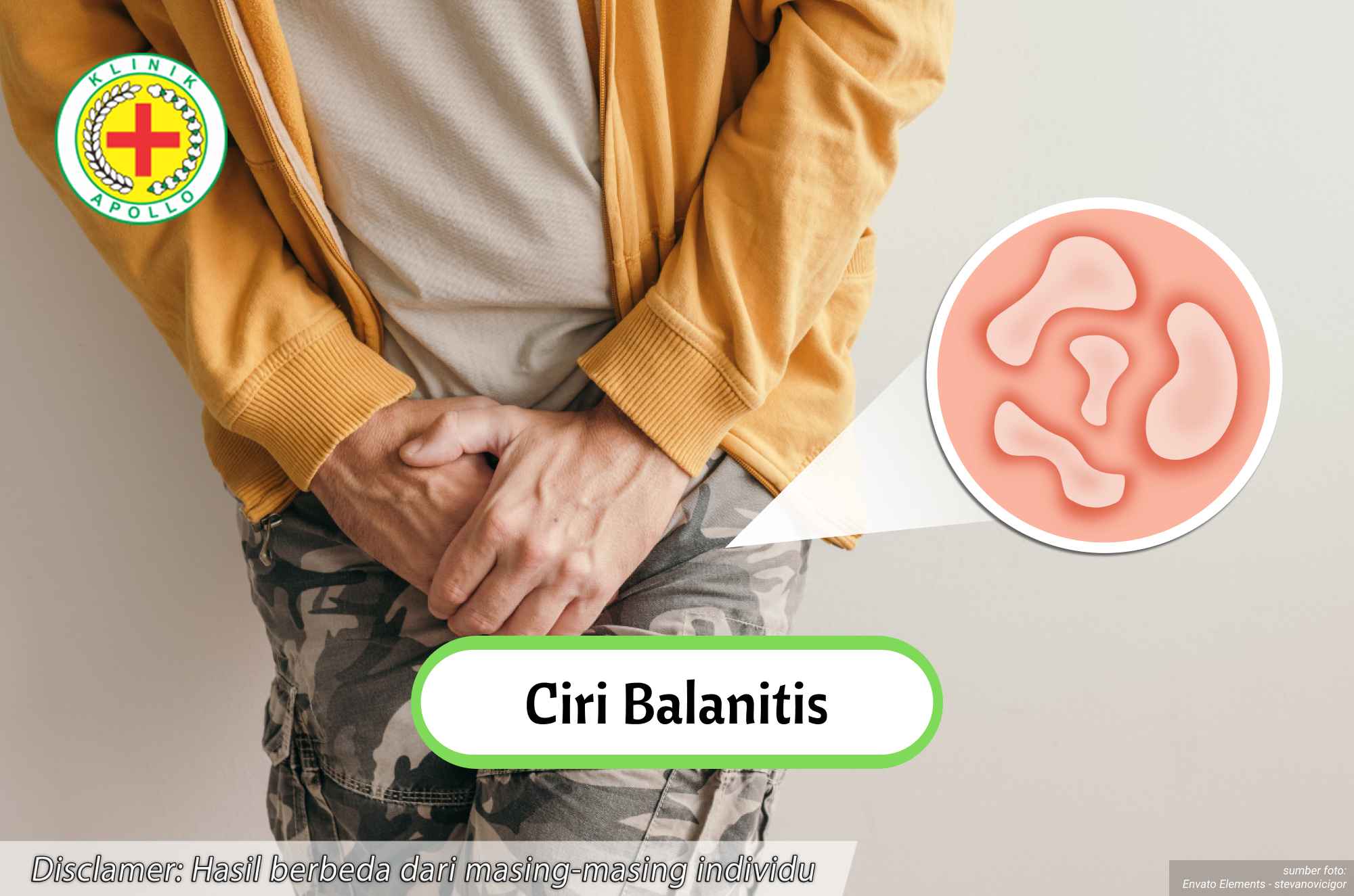 Ilustrasi Ciri Balanitis.