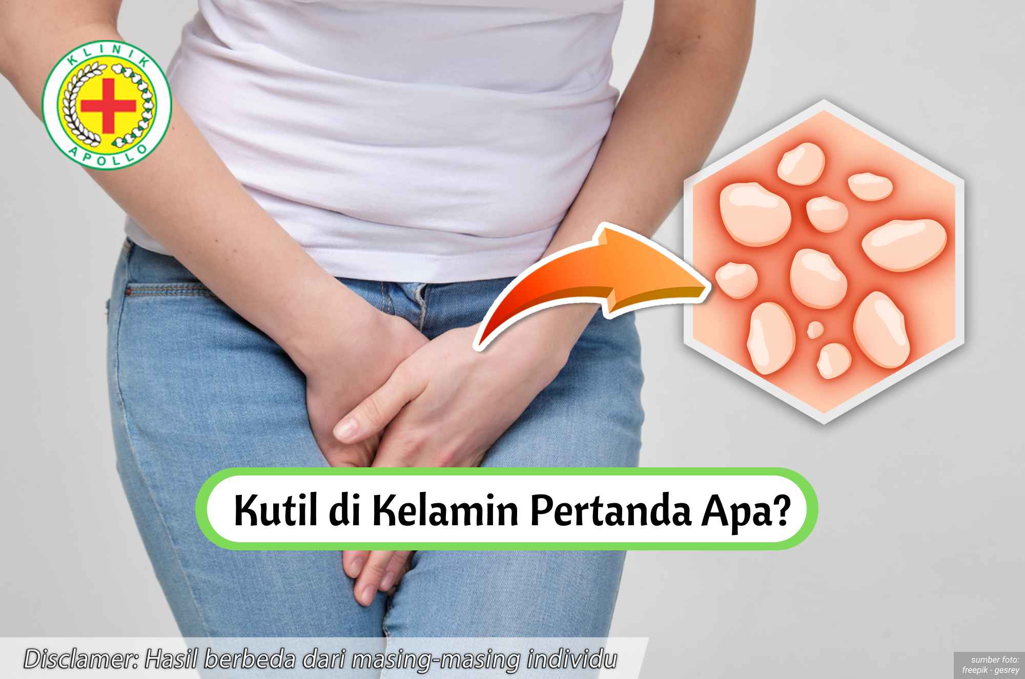 Ilustrasi Kutil di Kelamin Pertanda Apa?