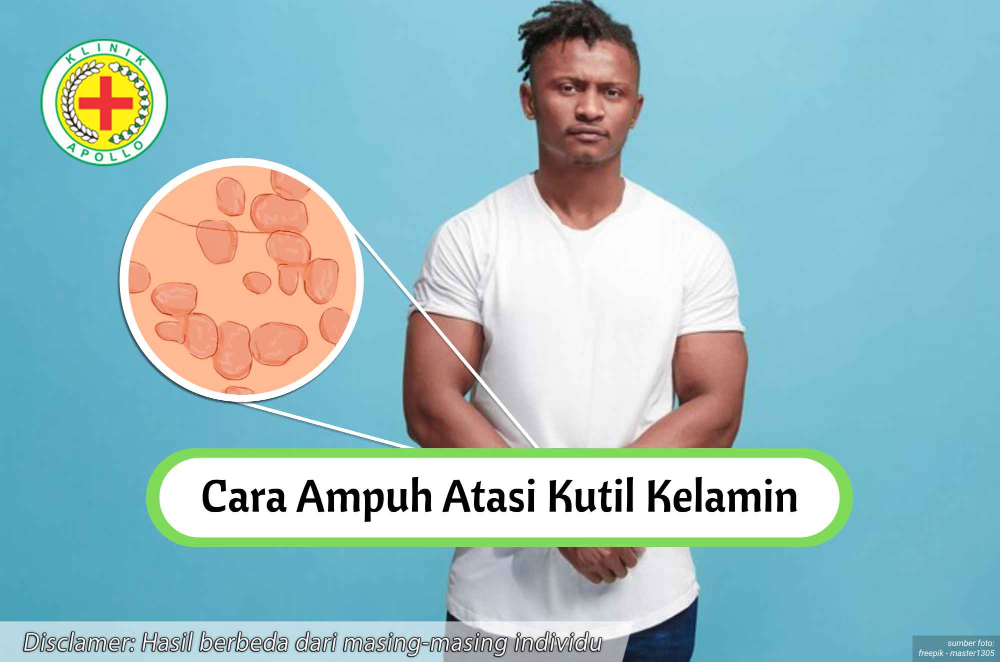 Ilustrasi Cara Ampuh Atasi Kutil Kelamin.