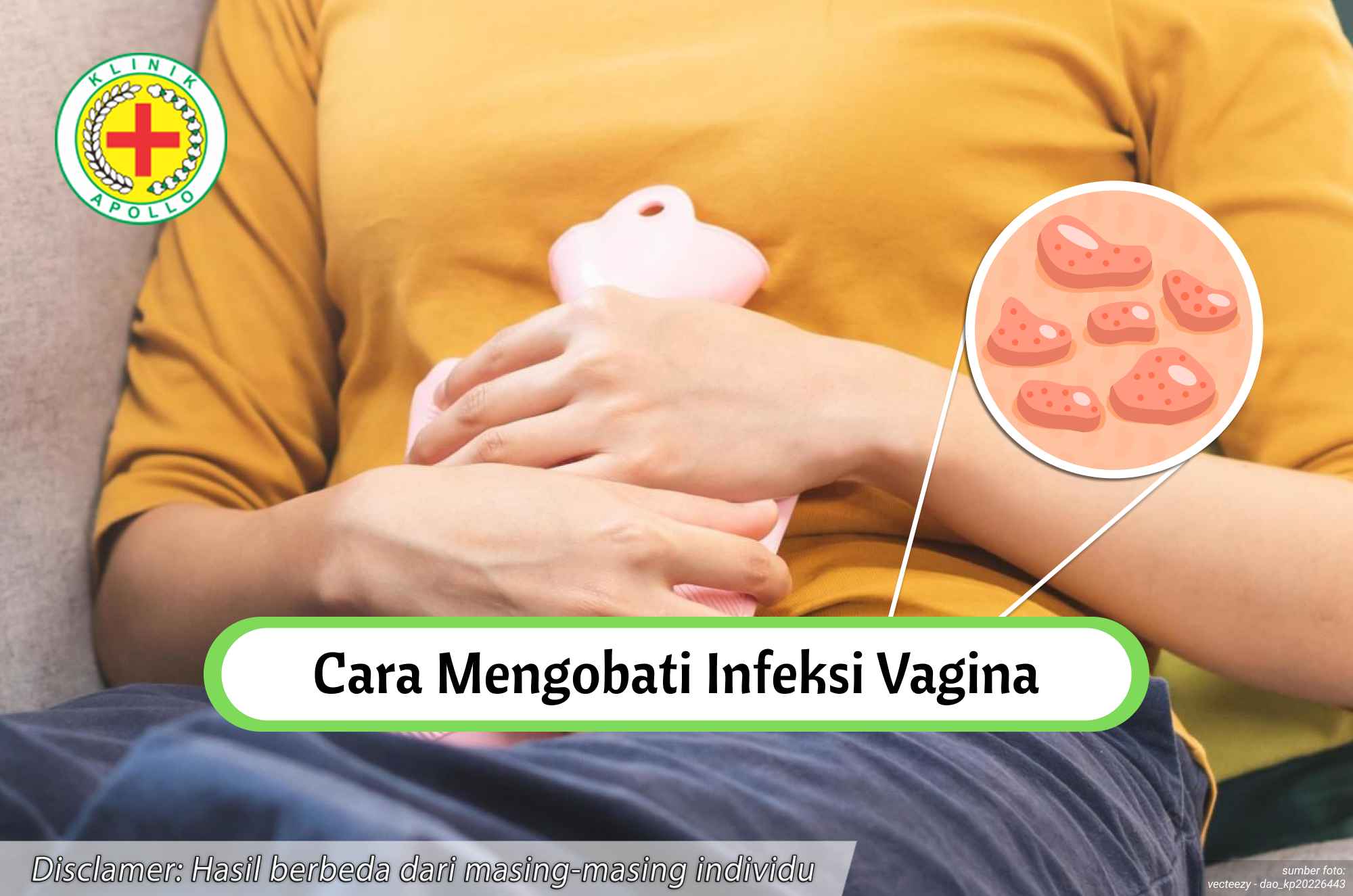 Ilustrasi Cara Mengobati Infeksi Vagina.