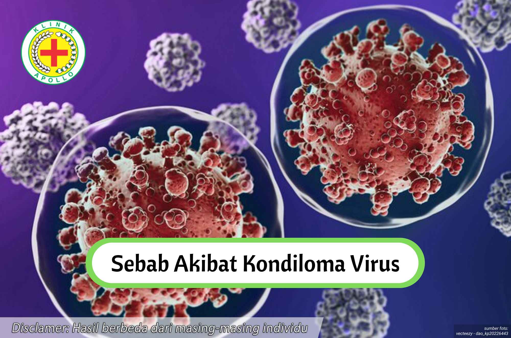 Ilustrasi Sebab Akibat Kondiloma Virus.