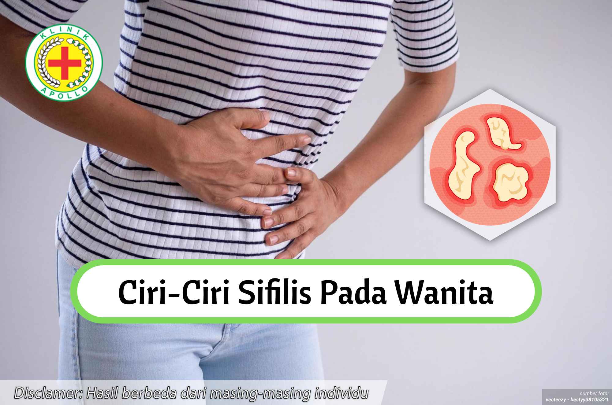 Ilustrasi Ciri-ciri Sifilis pada Wanita.