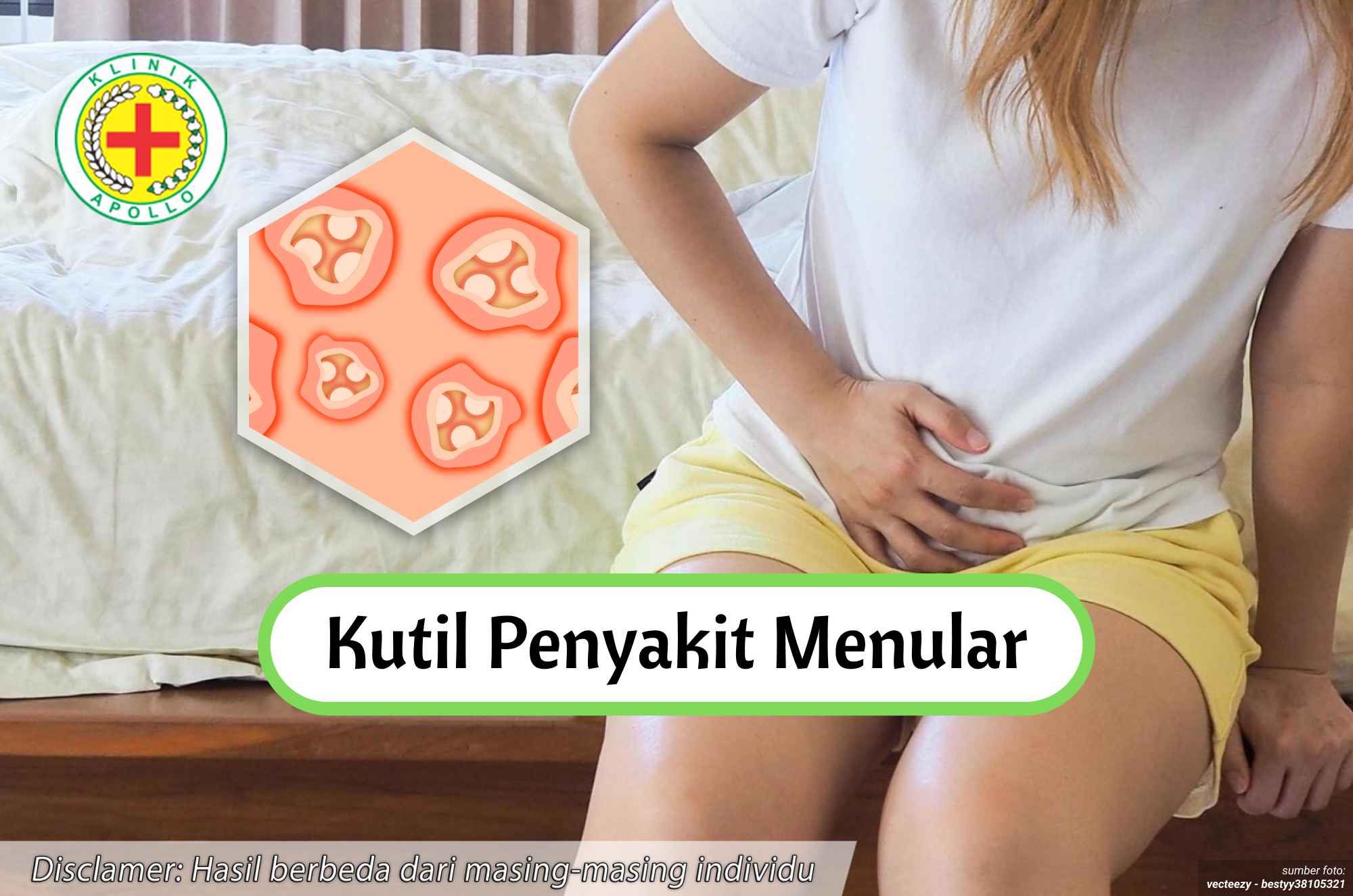 Ilustrasi Kutil Penyakit Menular.