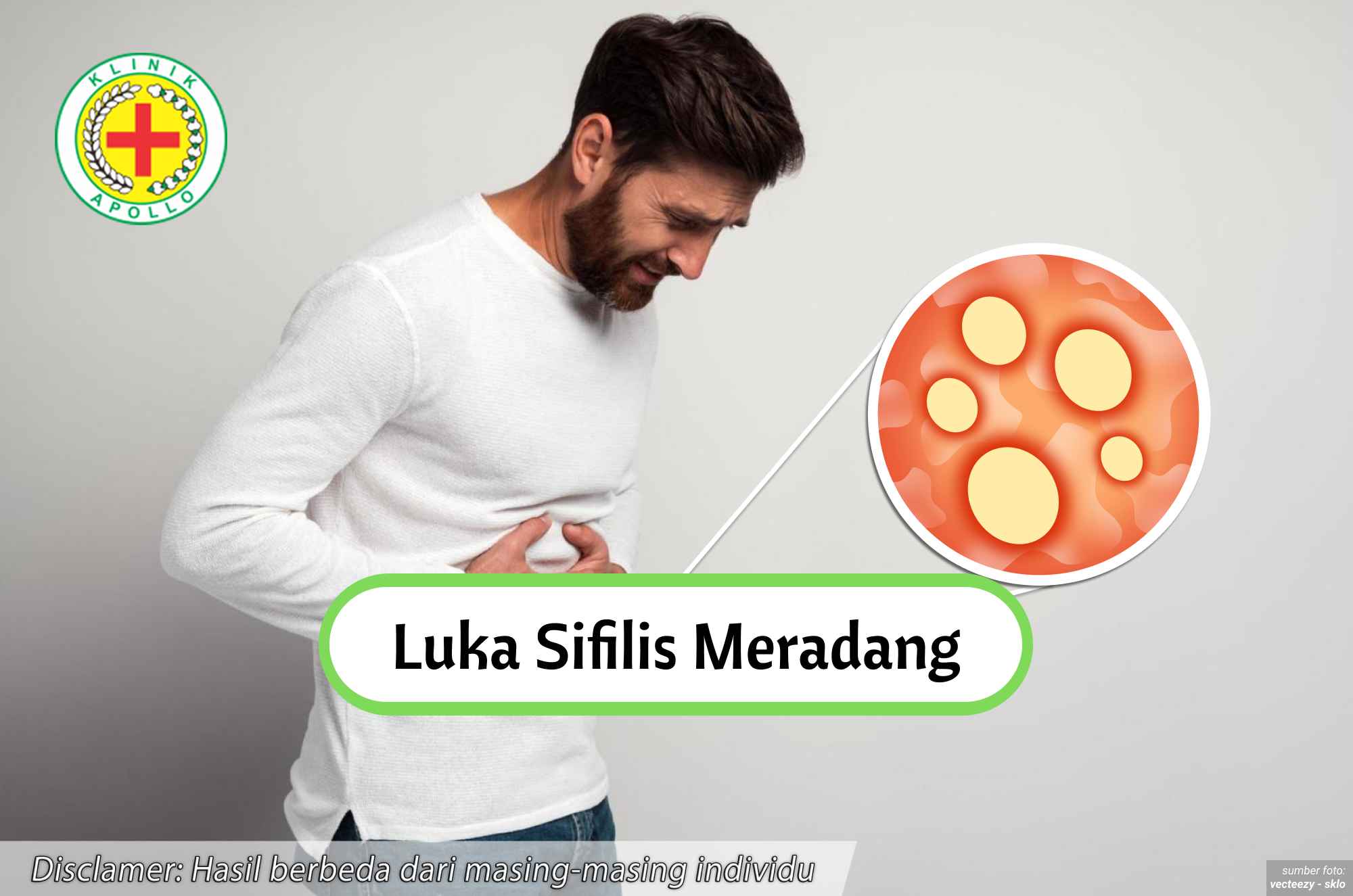 Ilustrasi Luka Sifilis Meradang.