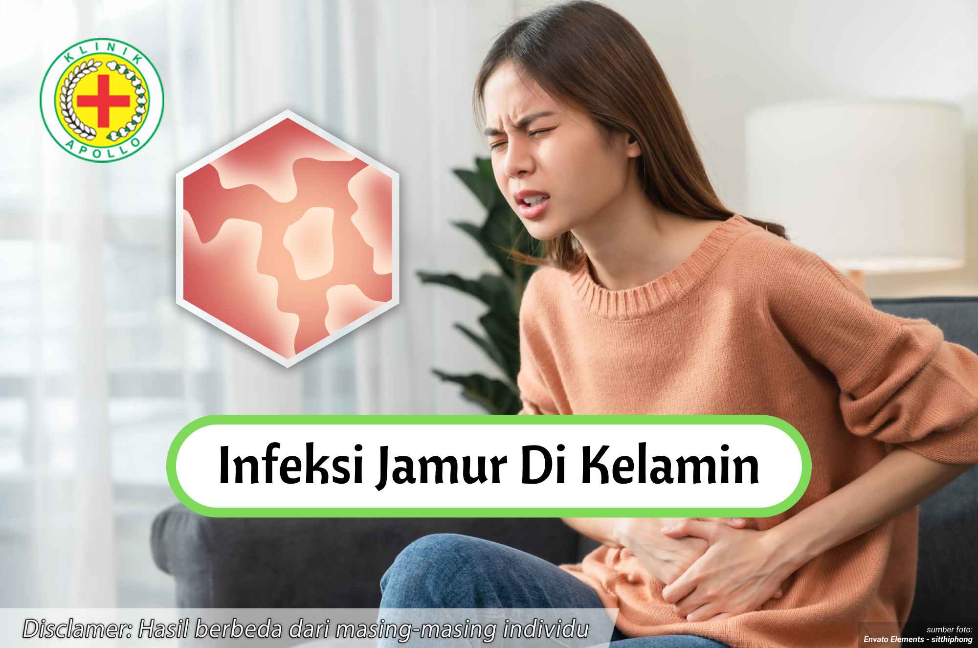 Ilustrasi Infeksi Jamur di Kelamin.