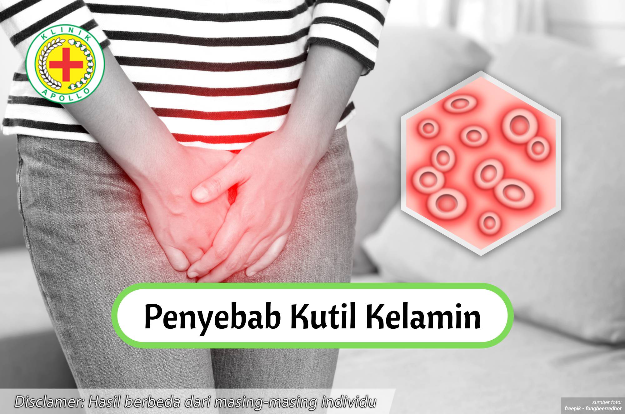 Ilustrasi Penyebab Kutil Kelamin.