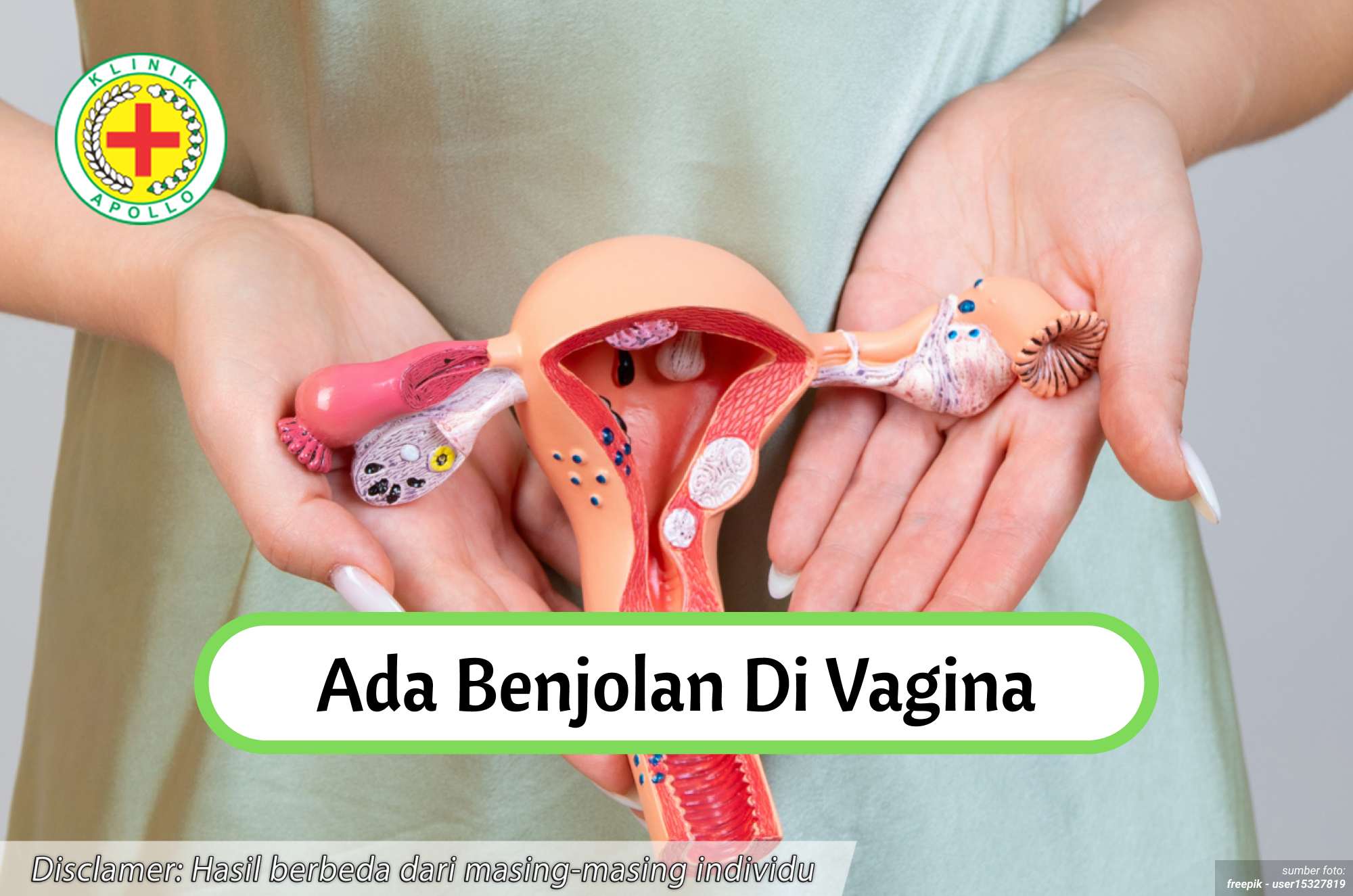 Ilustrasi Ada Benjolan di Vagina.