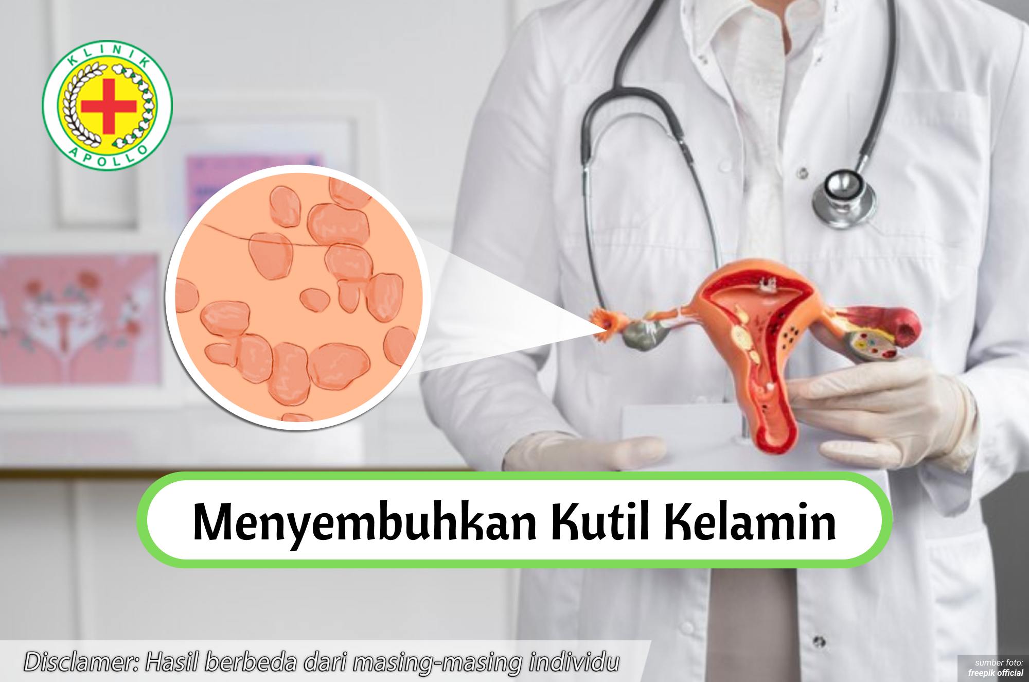 Ilustrasi Menyembuhkan Kutil Kelamin.