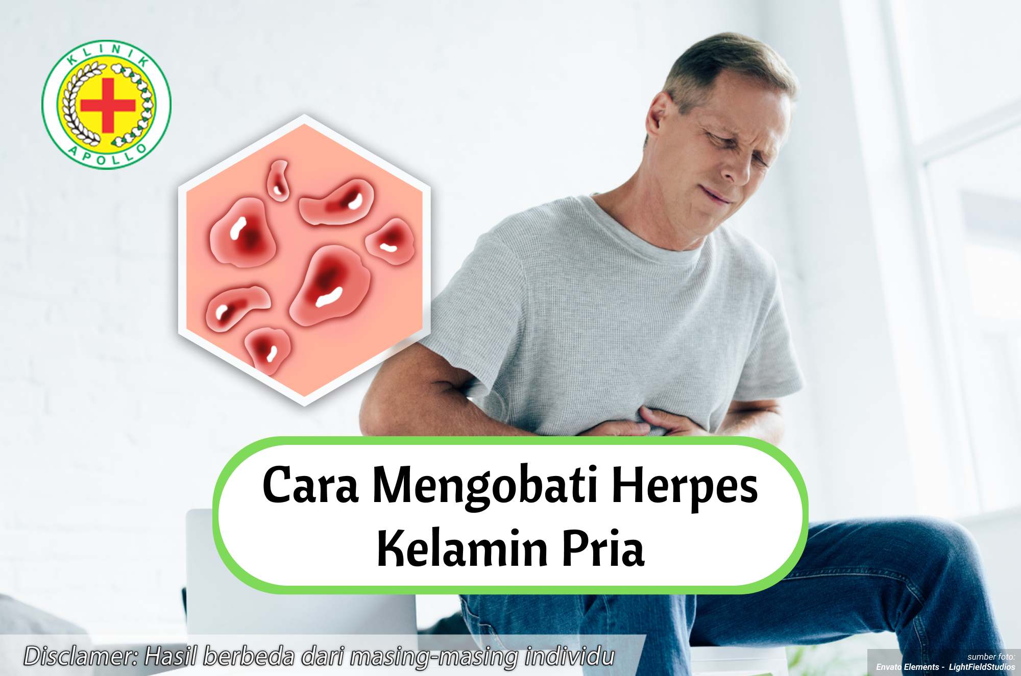Ilustrasi Cara Mengobati Herpes Kelamin Pria.