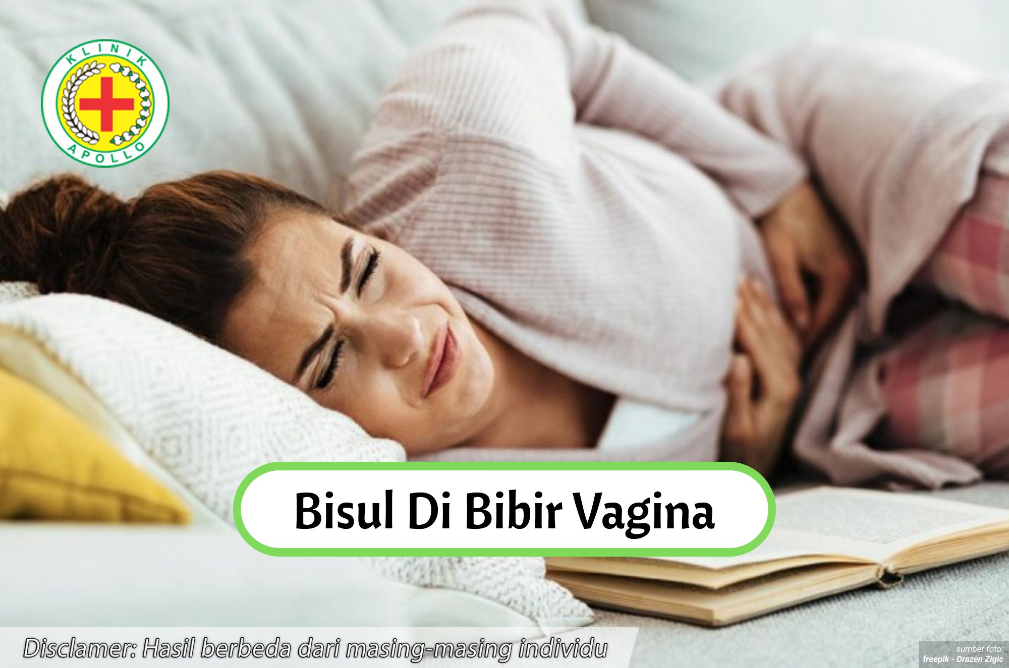 Ilustrasi Bisul di Bibir Vagina.