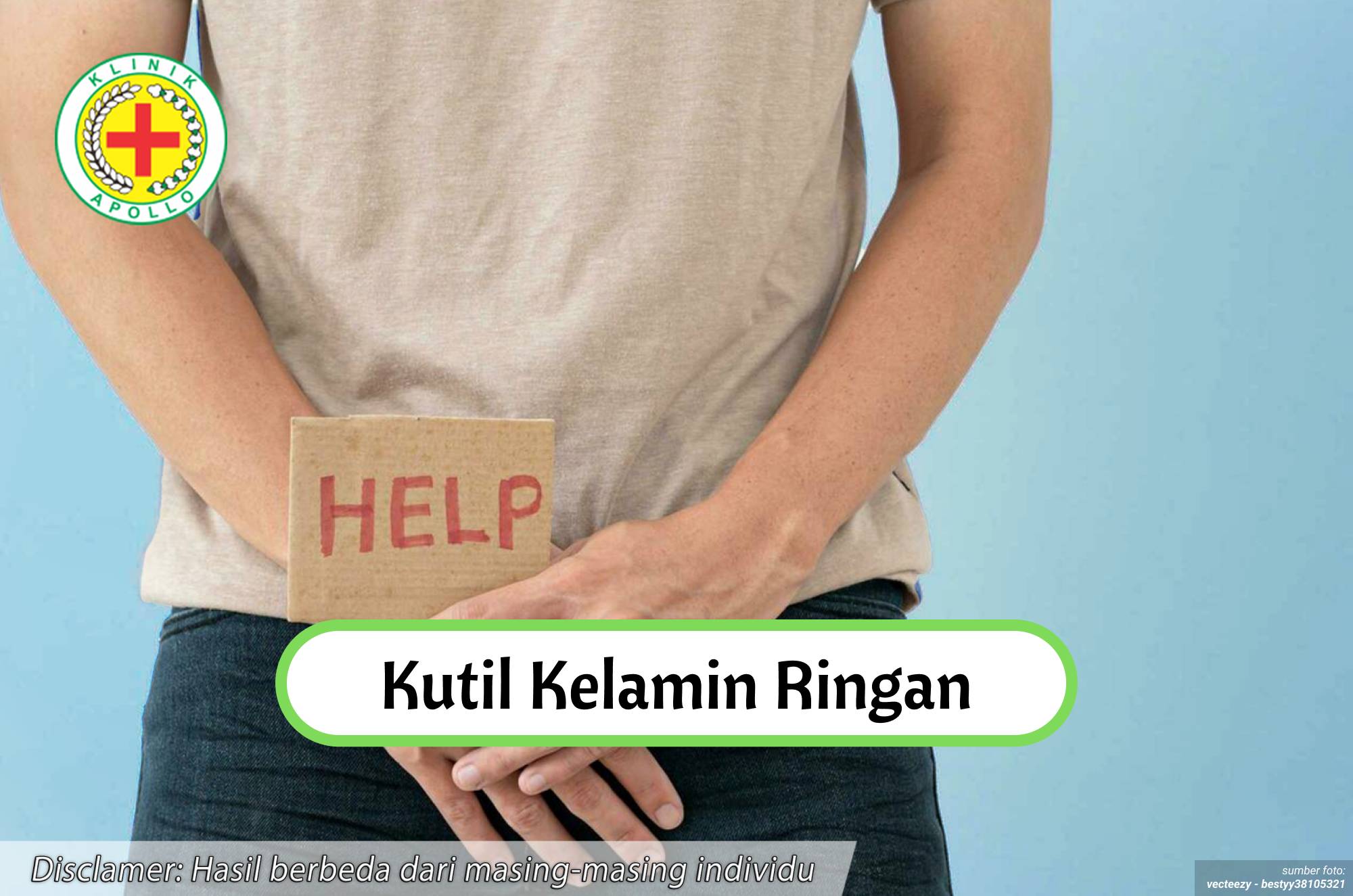 Ilustrasi Kutil Kelamin Ringan.