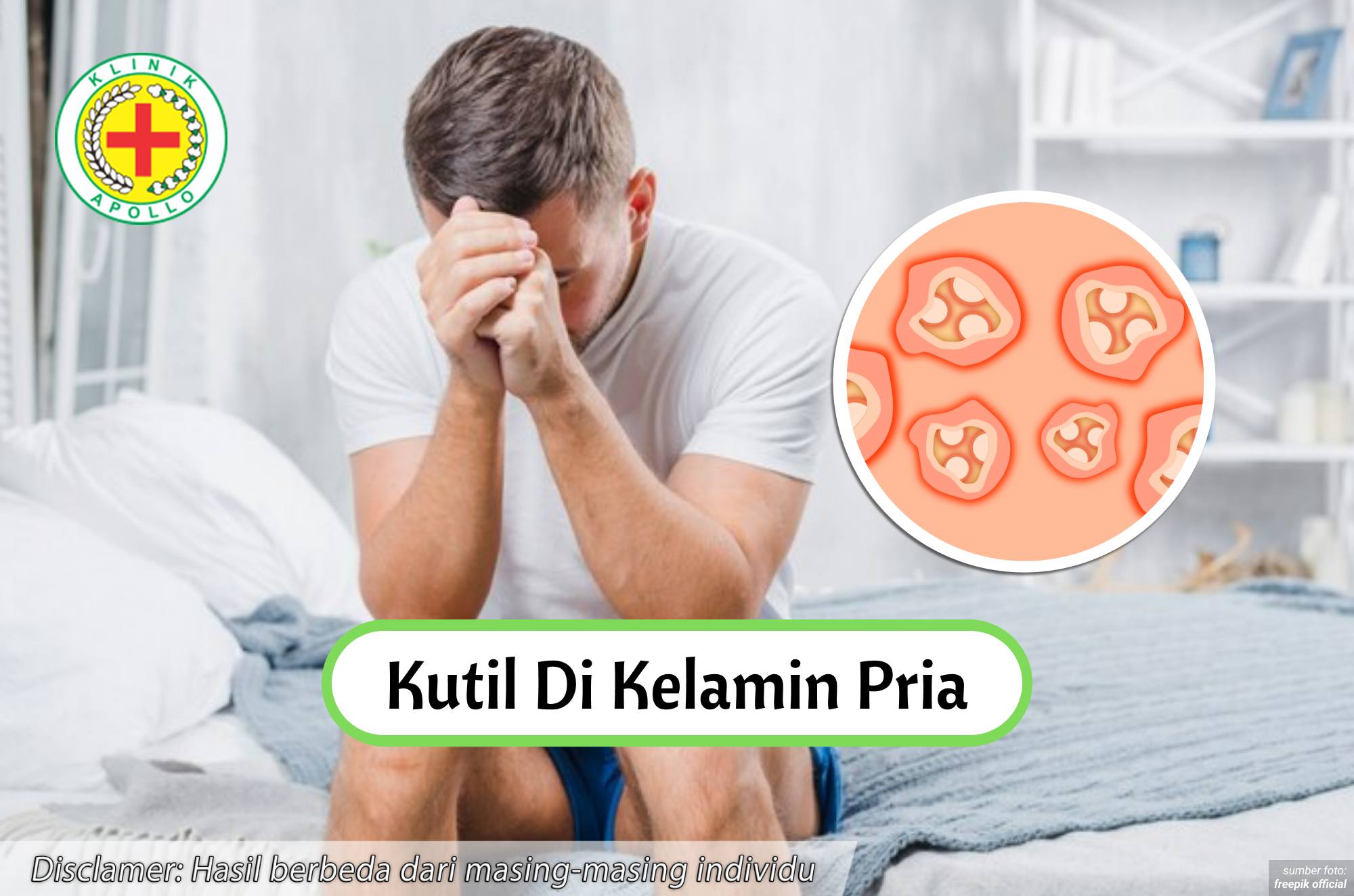 Ilustrasi Kutil di Kelamin Pria.