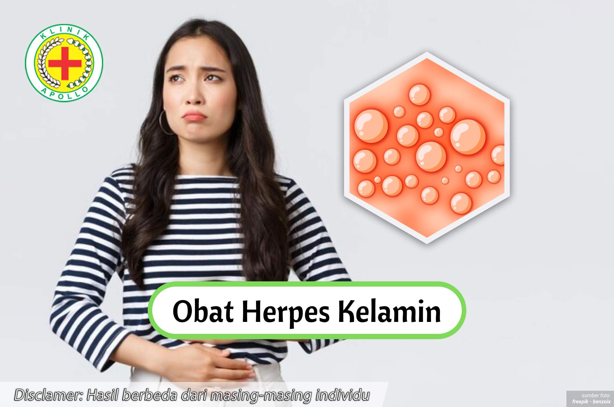 Ilustrasi Obat Herpes Kelamin.