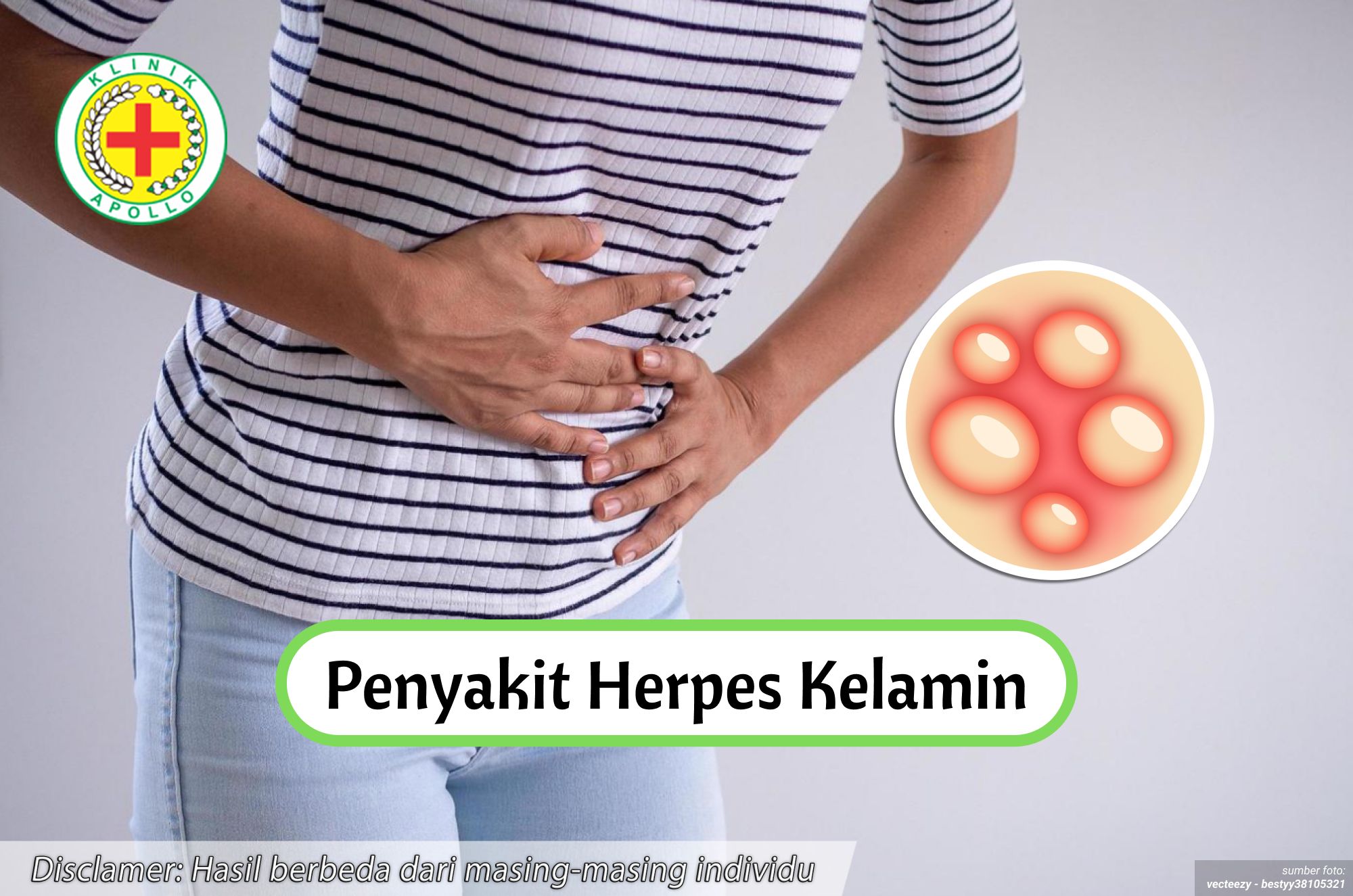 Ilustrasi Penyakit Herpes Kelamin.