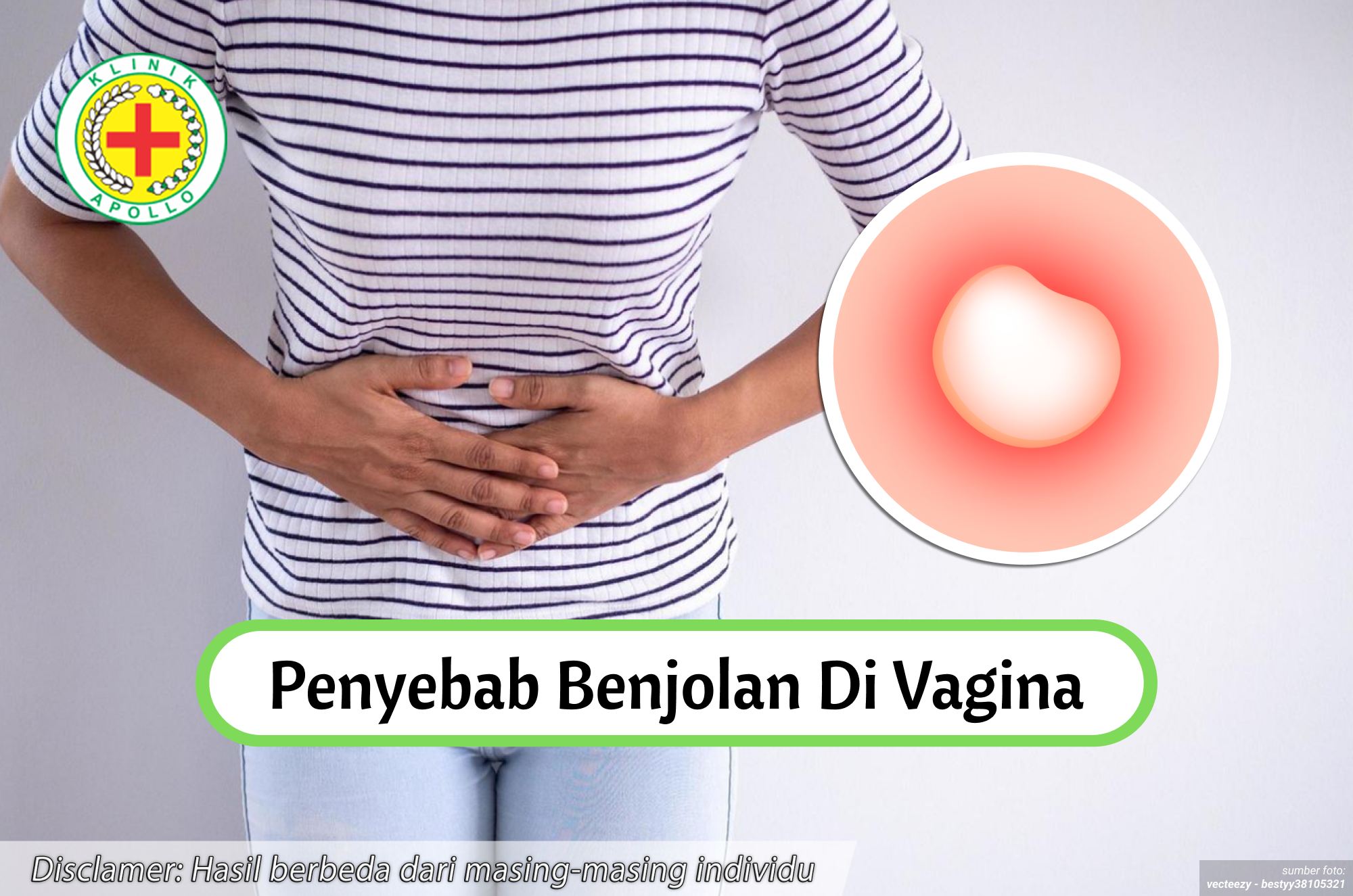 Ilustrasi Penyebab Benjolan di Vagina.