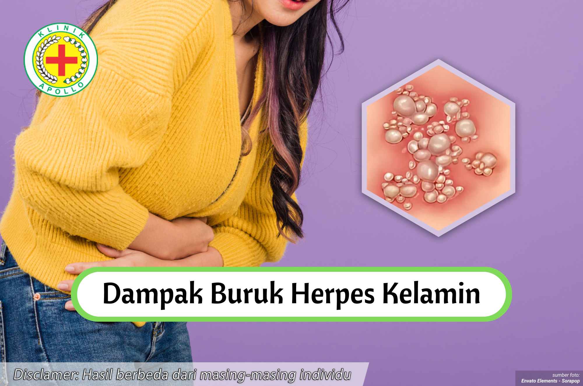 Ilustrasi Dampak Buruk Herpes Kelamin.