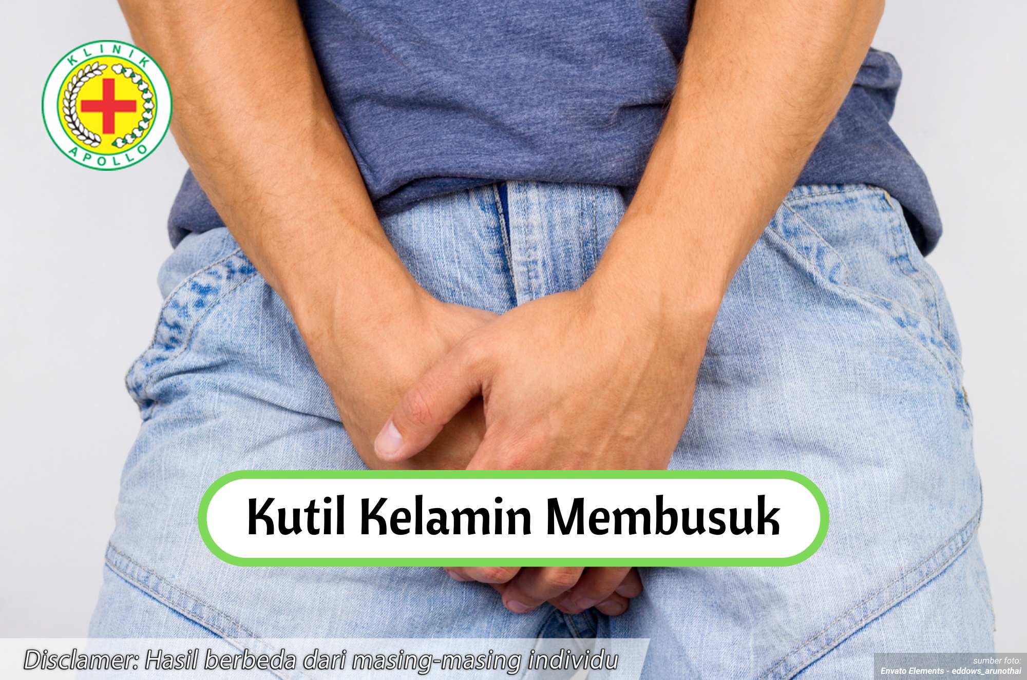 Ilustrasi Kutil Kelamin Membusuk.