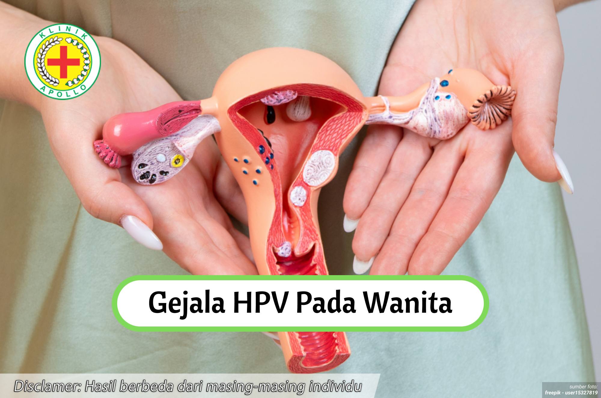 Ilustrasi Gejala HPV pada Wanita.