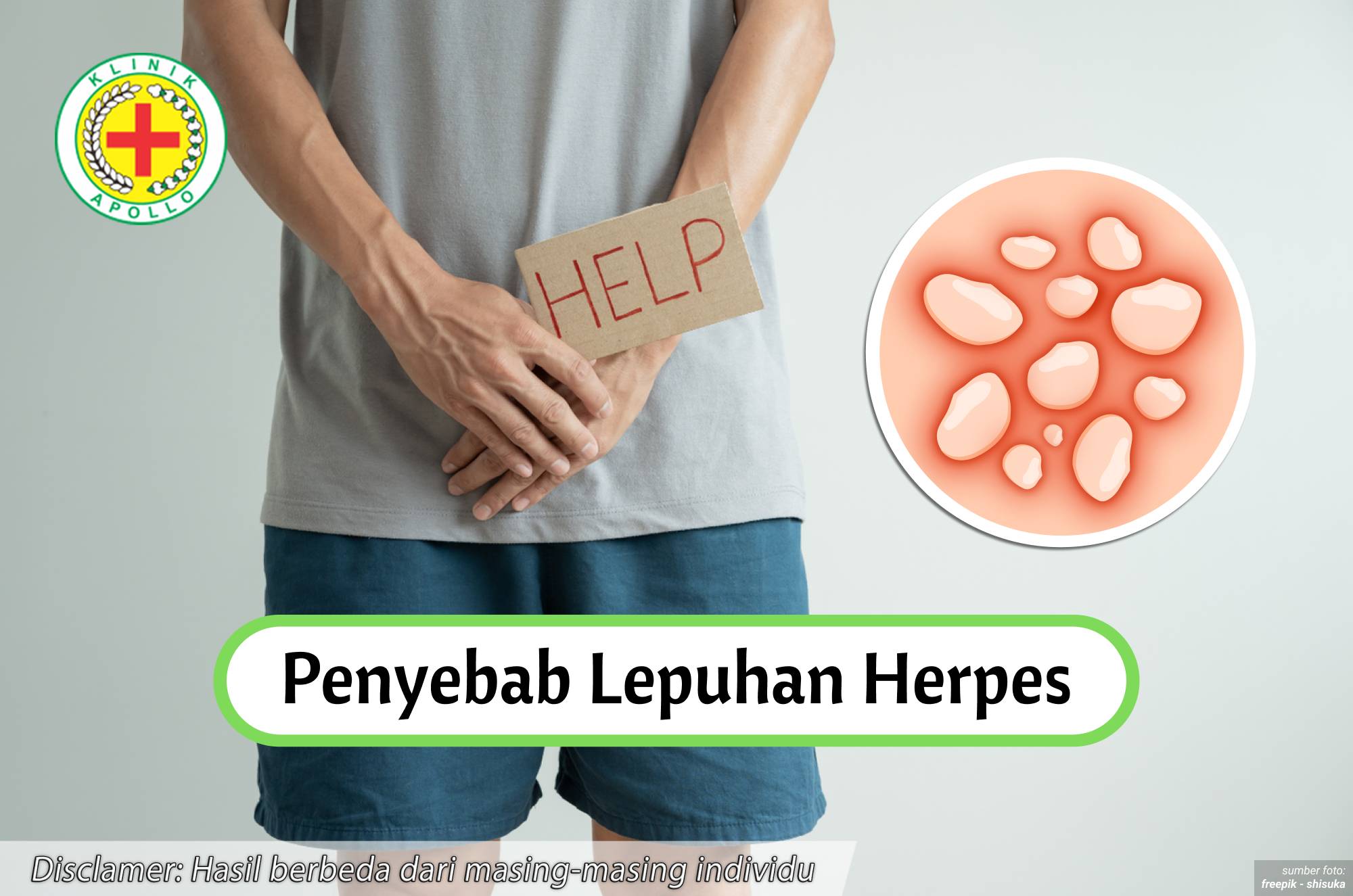 Ilustrasi Penyebab Lepuhan Herpes.