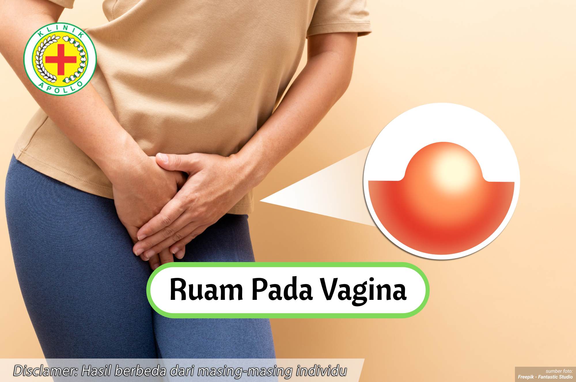 Ilustrasi Ruam pada Vagina.