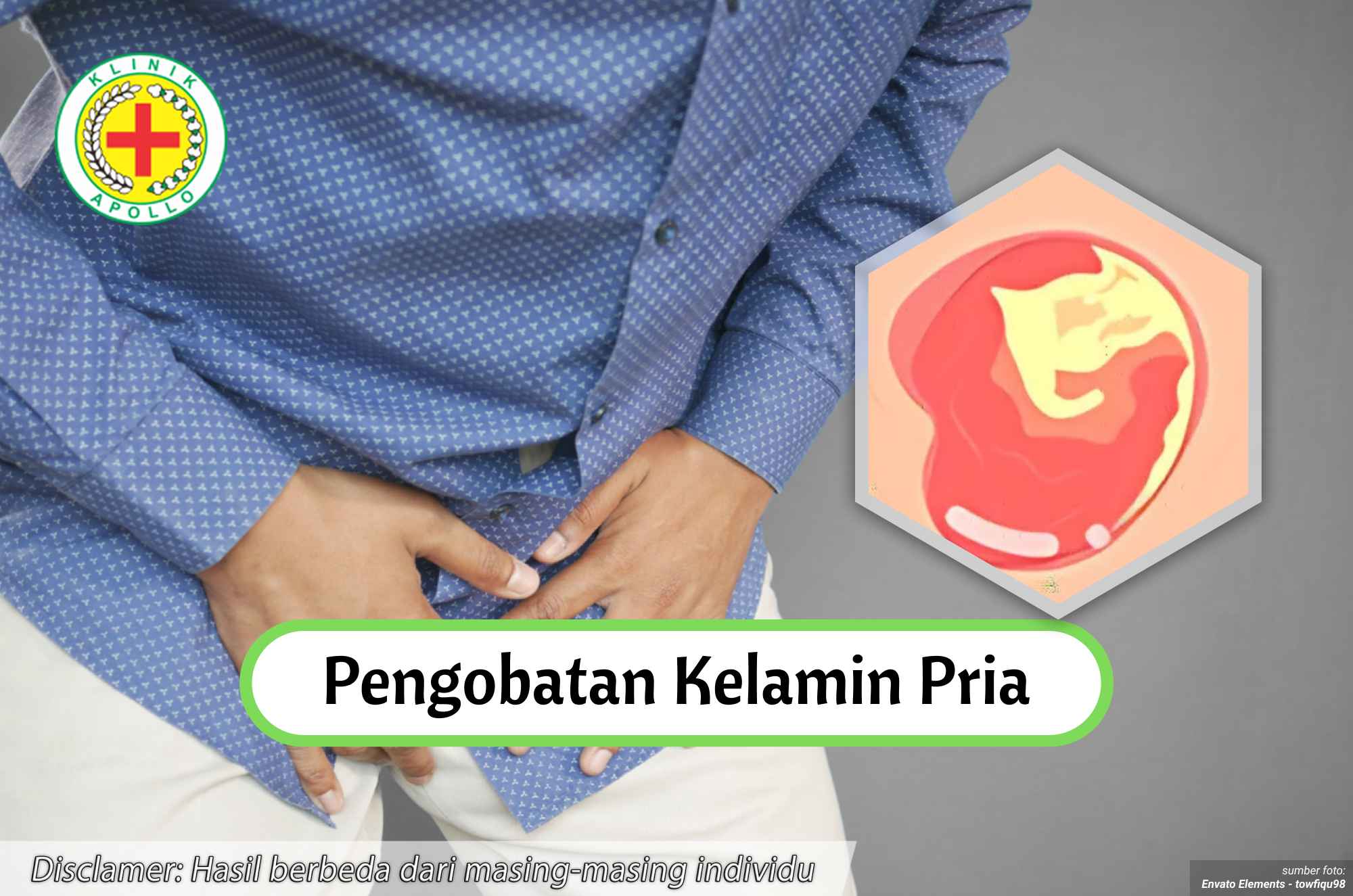 Ilustrasi Pengobatan Kelamin Pria.