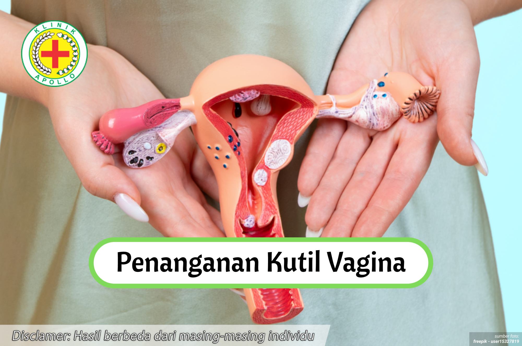 Ilustrasi Penanganan Kutil Vagina.