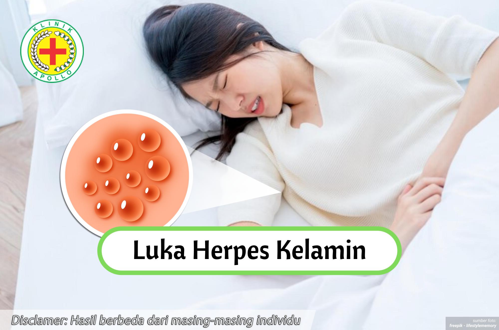 Ilustrasi Luka Herpes Kelamin.