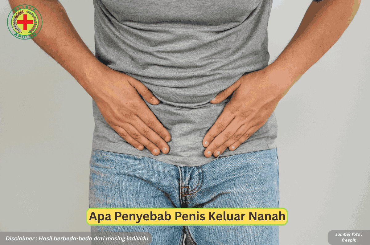 Ilustrasi Apa Penyebab Penis Keluar Nanah.