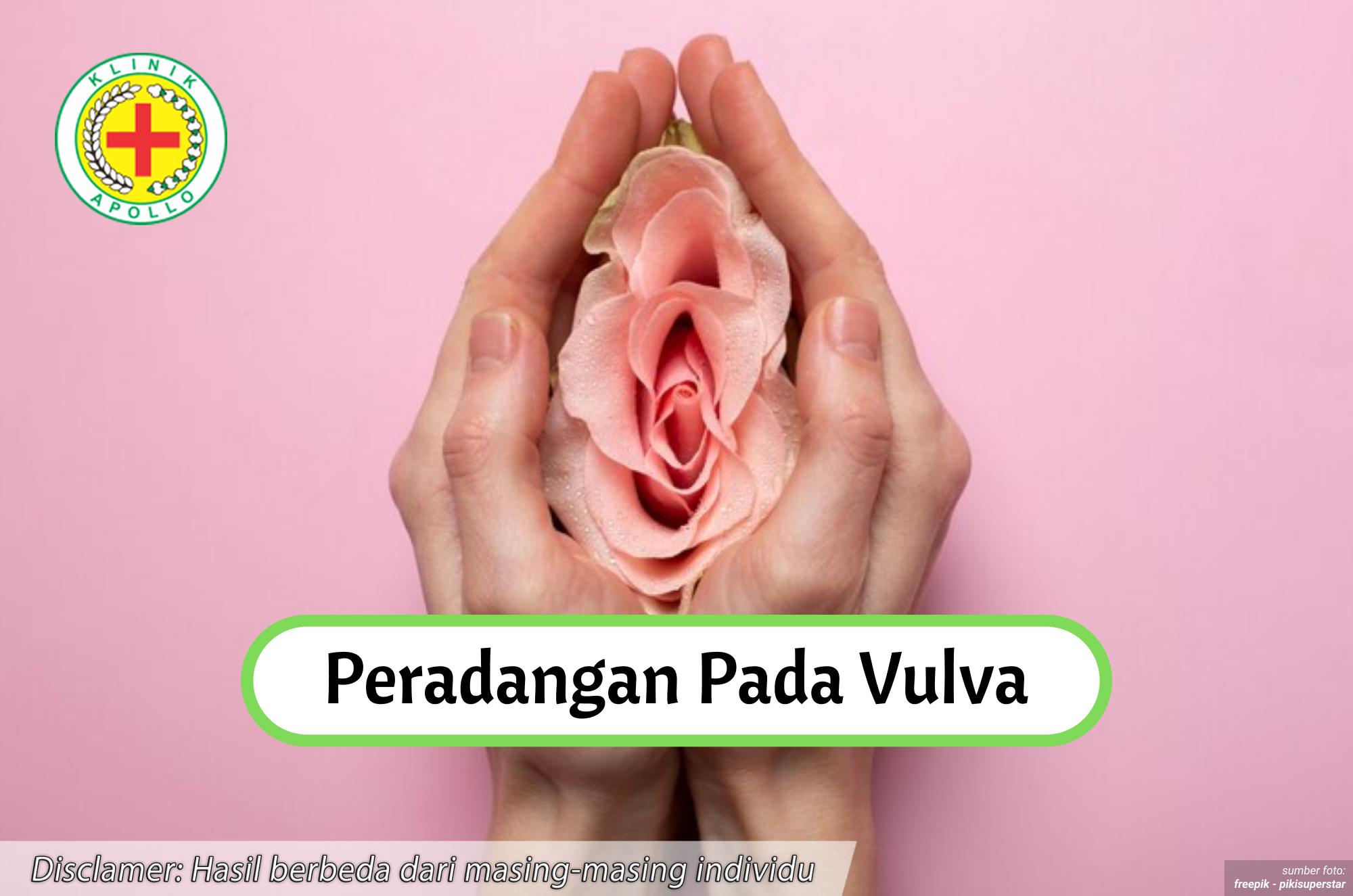 Ilustrasi Peradangan pada Vulva.