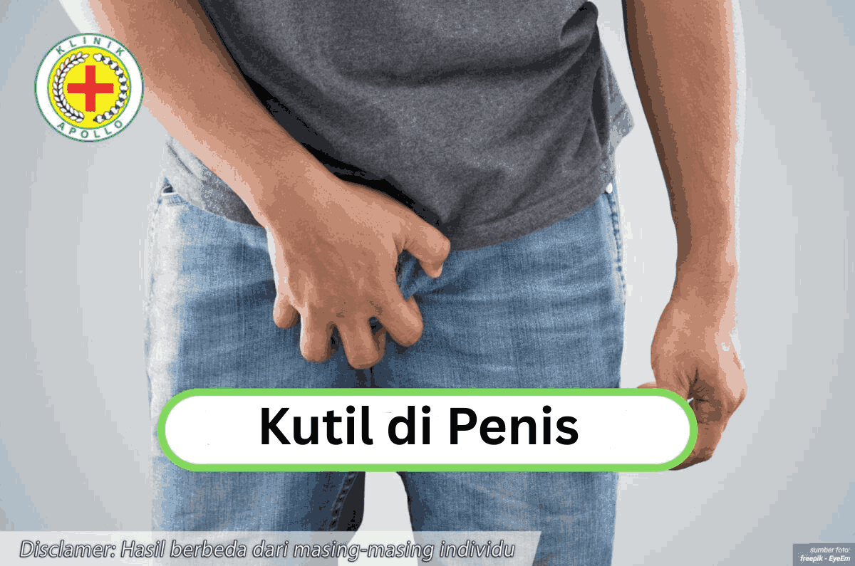 Ilustrasi Kutil di Penis.