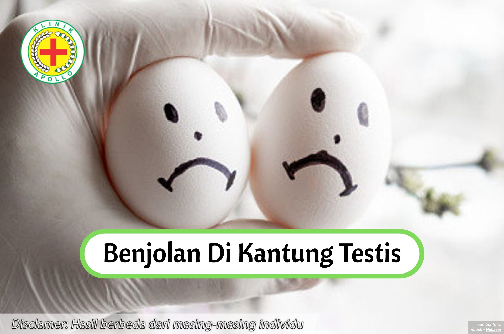Ilustrasi Benjolan di Kantung Testis.