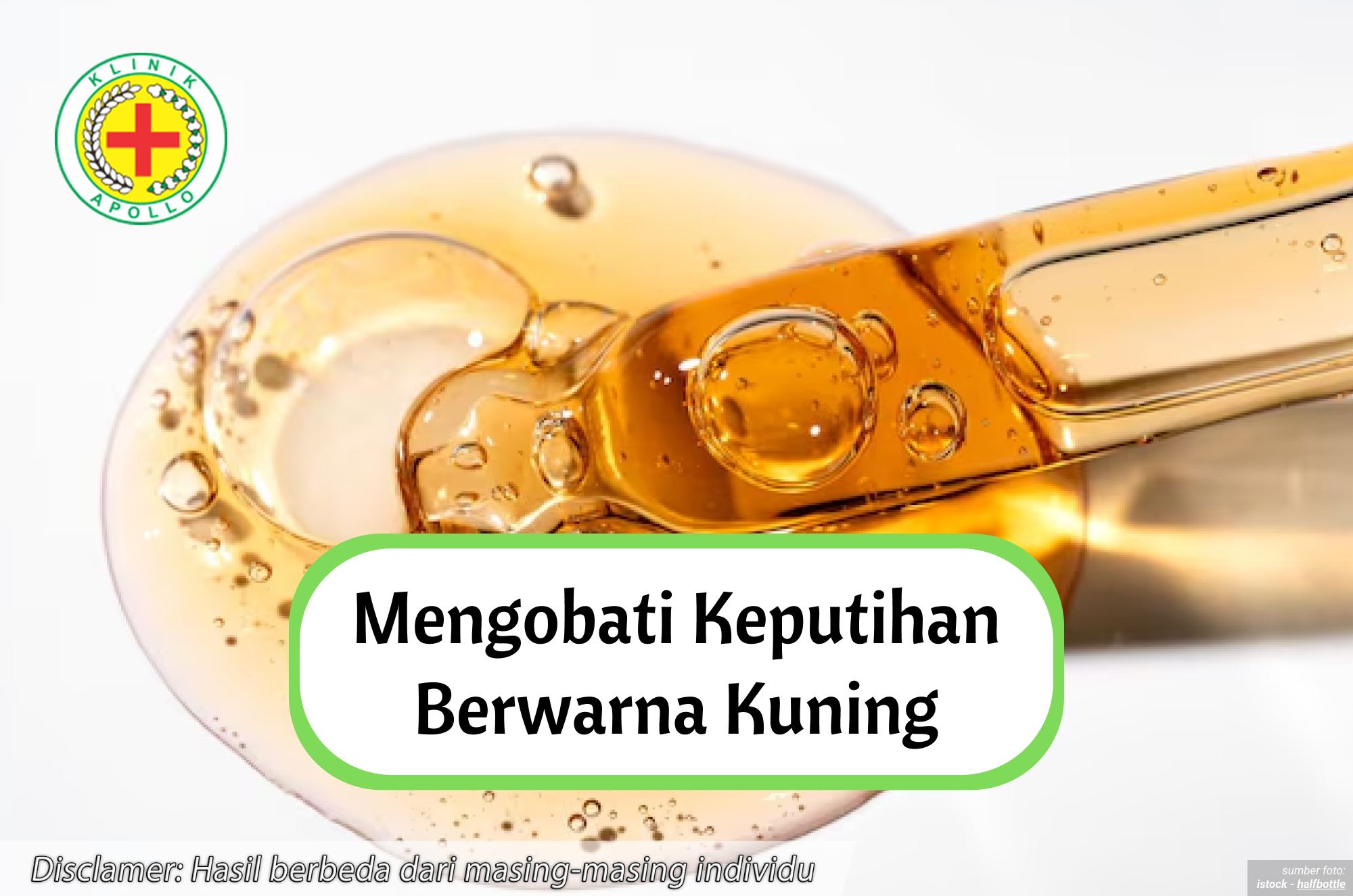 Ilustrasi Mengobati Keputihan Berwarna Kuning.