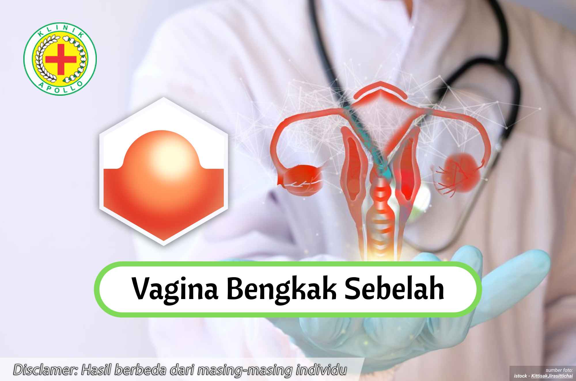 Ilustrasi Vagina Bengkak Sebelah.
