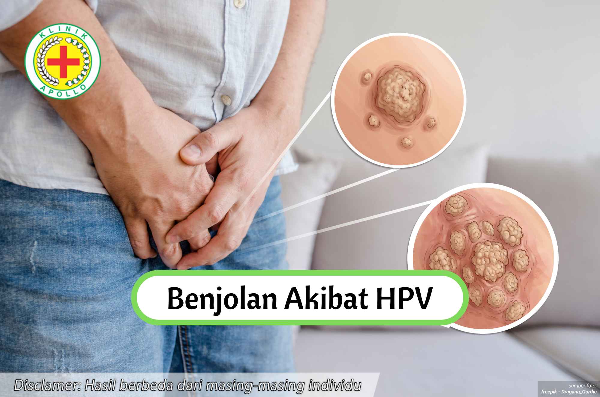 Ilustrasi Benjolan Akibat HPV.