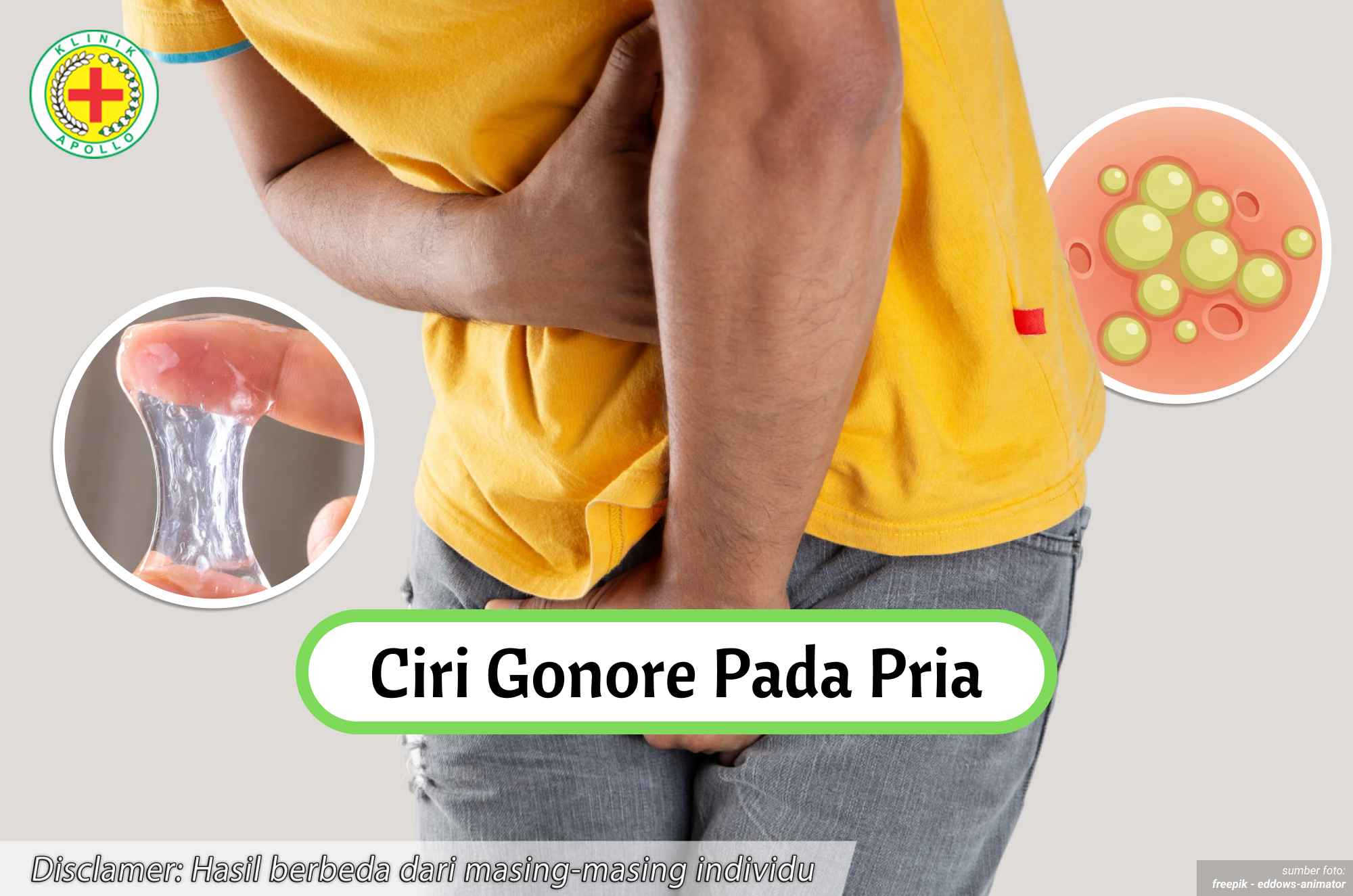 Ilustrasi Ciri Gonore pada Pria.