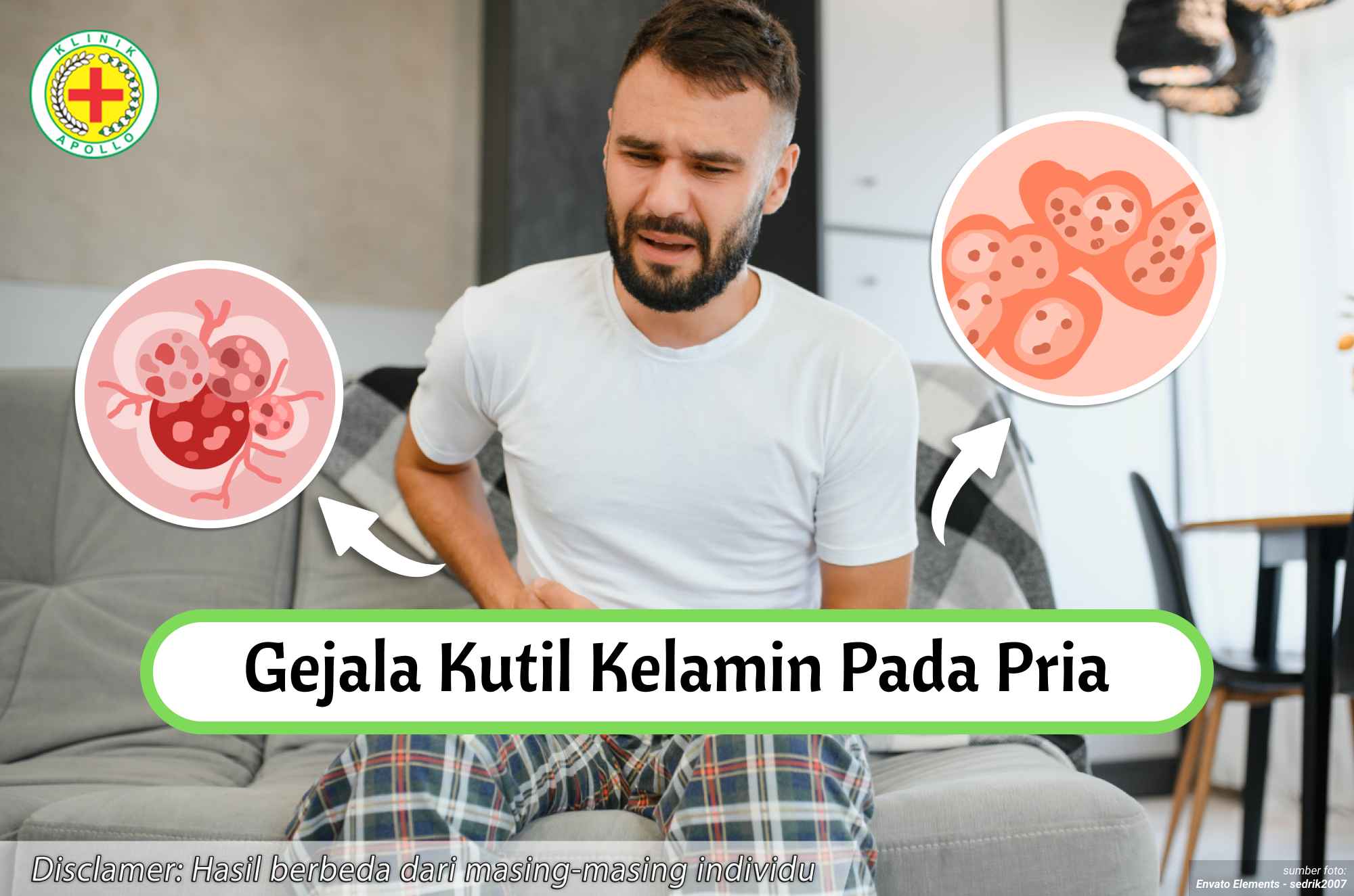 Ilustrasi Gejala Kutil Kelamin pada Pria.