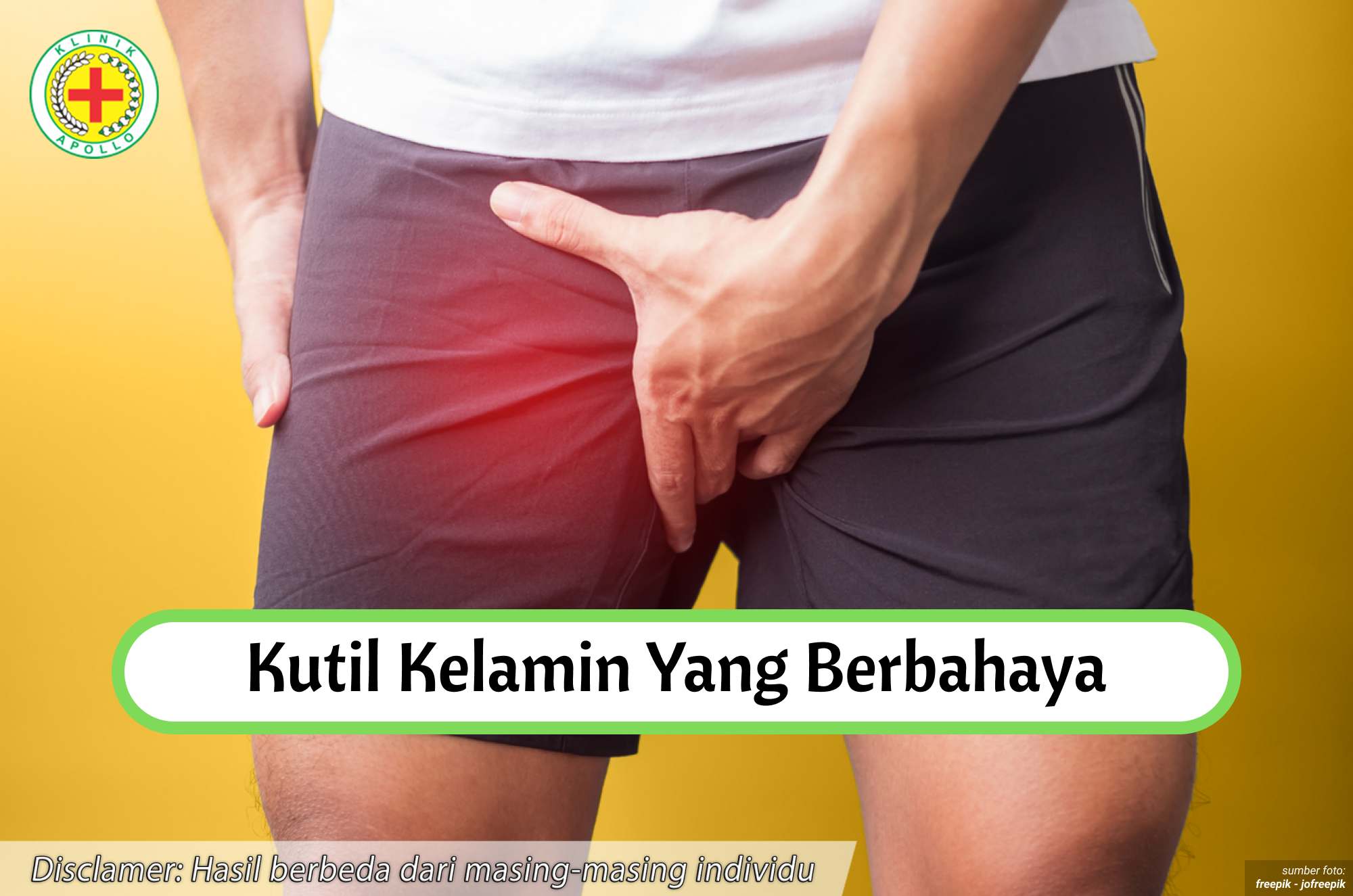 Ilustrasi Kutil Kelamin yang Berbahaya.