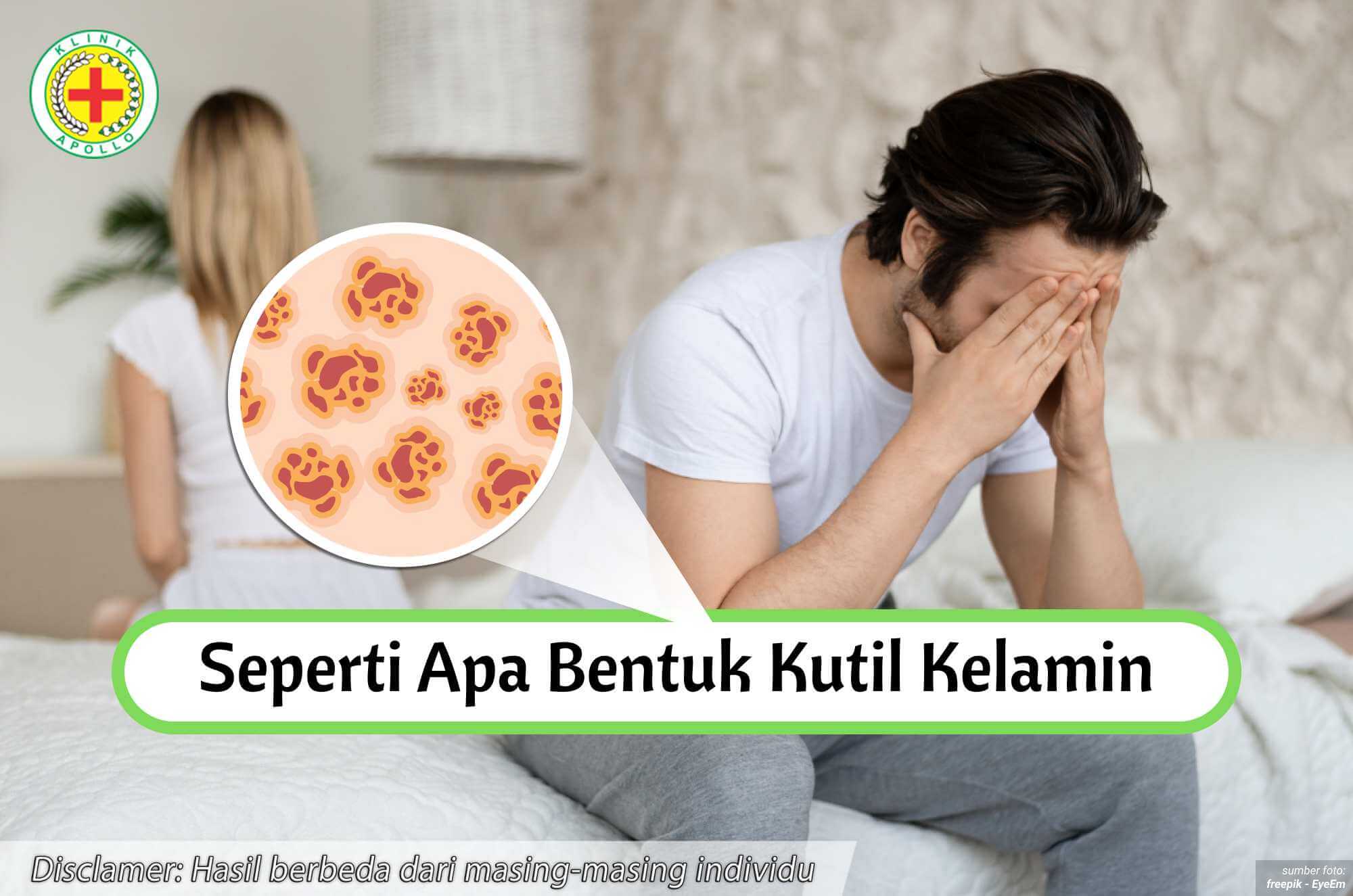 Ilustrasi Seperti Apa Bentuk Kutil Kelamin.